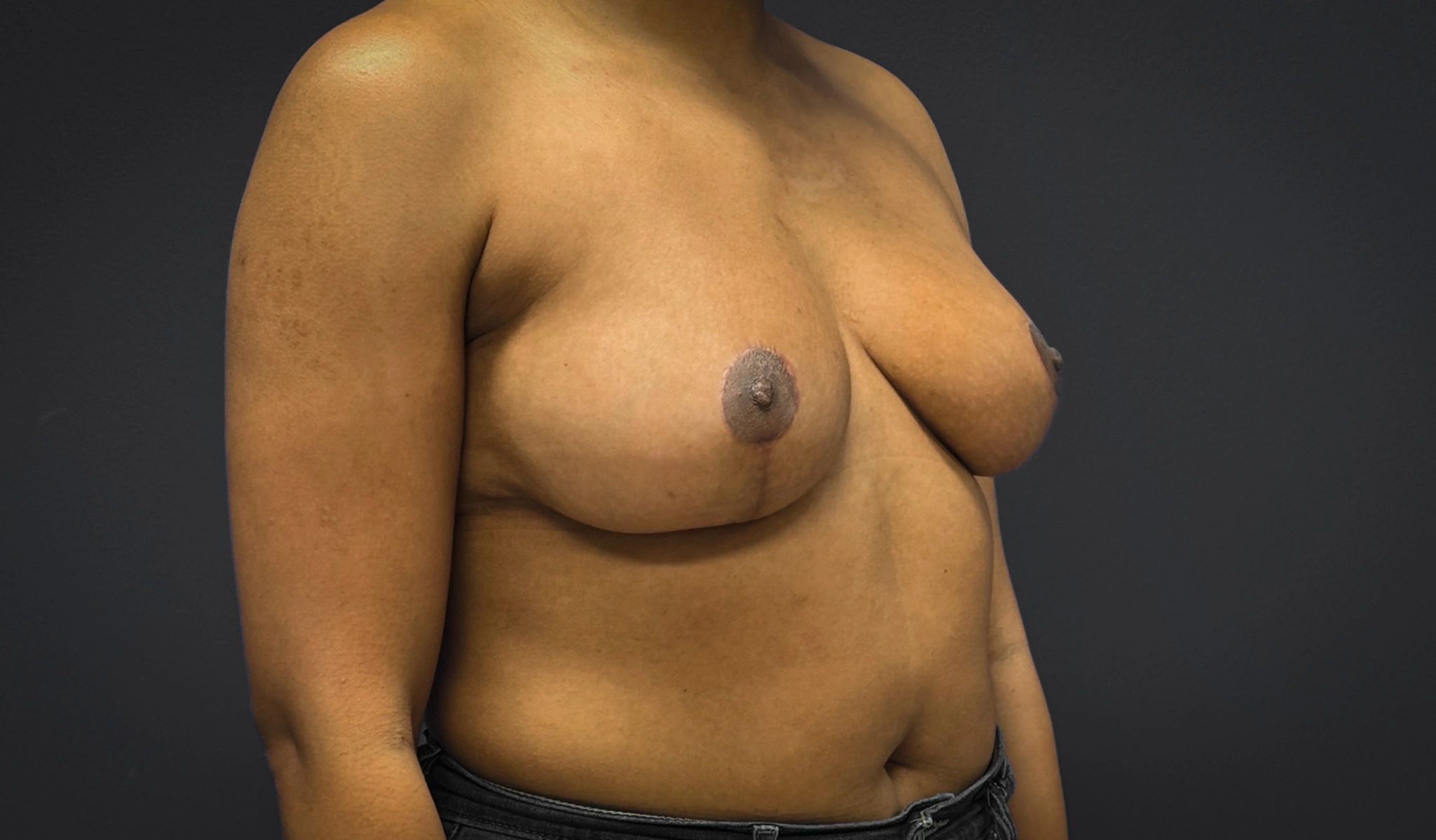 Breast-Reduction-Case--7089 | After Breast Reduction 4