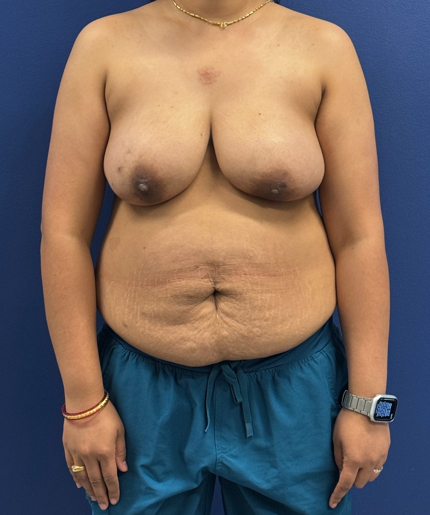 Nipple-Reconstruction-Case--1343 | Before Breast Reconstruction 1