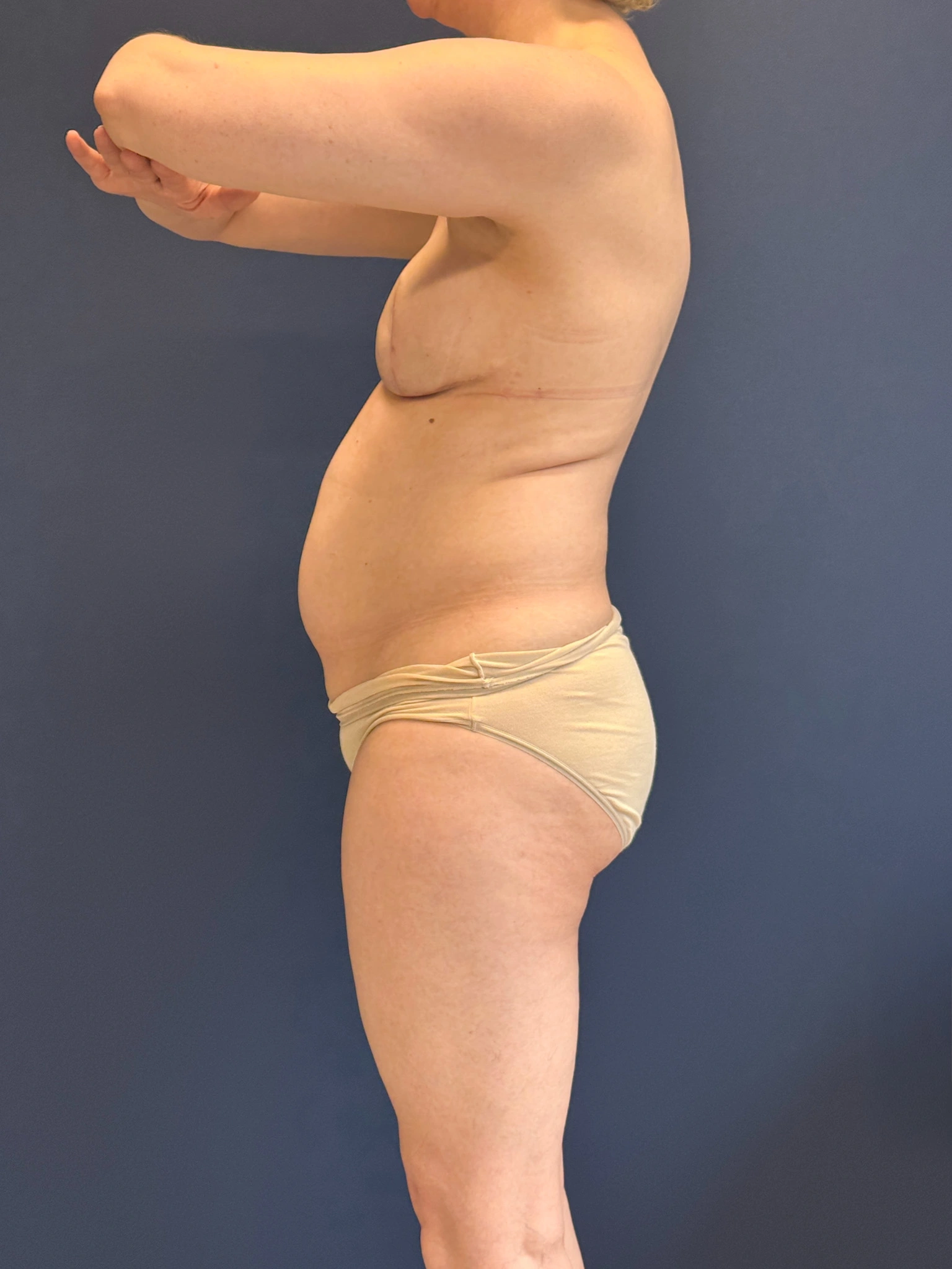 Abdominoplasty-Case--4180 | Before Tummy Tuck 2