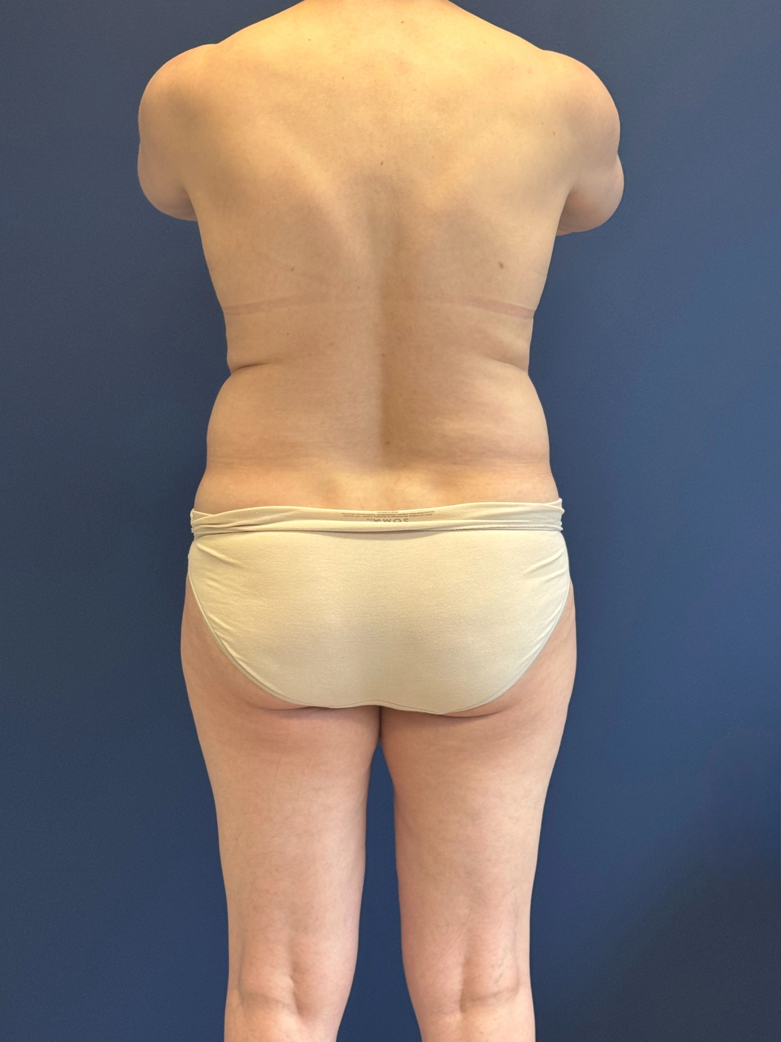 Abdominoplasty-Case--4180 | Before Tummy Tuck 6