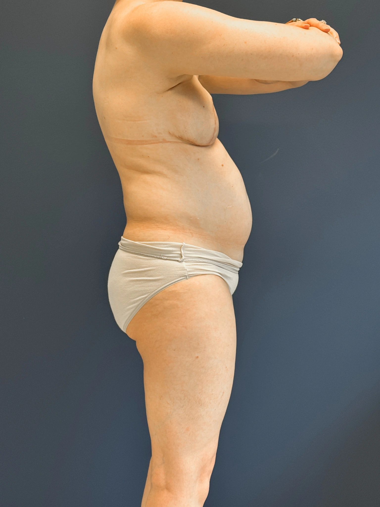 Abdominoplasty-Case--4180 | Before Tummy Tuck 3