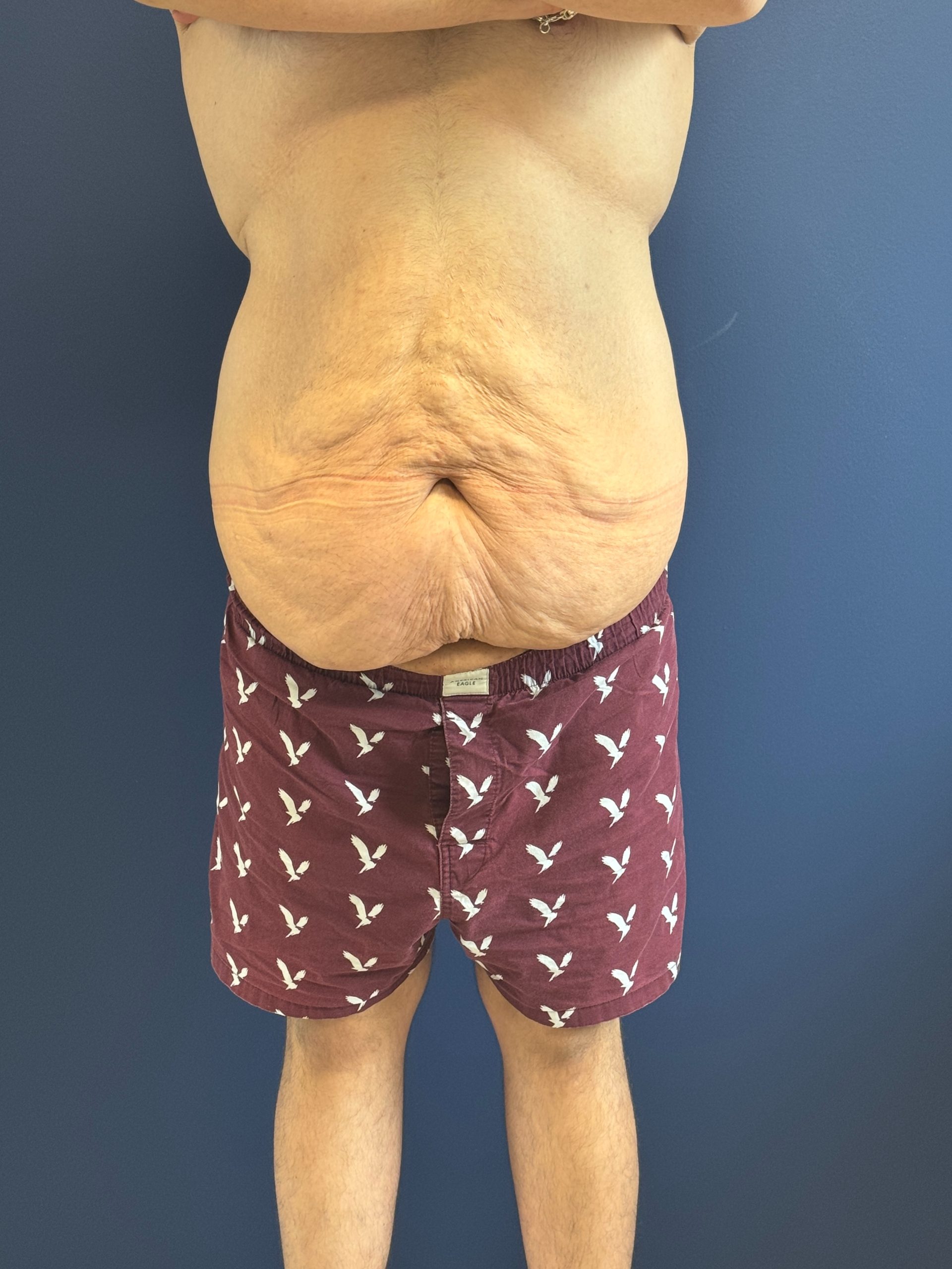 Body-Lift-Case--1927 | Before Body Lift 1