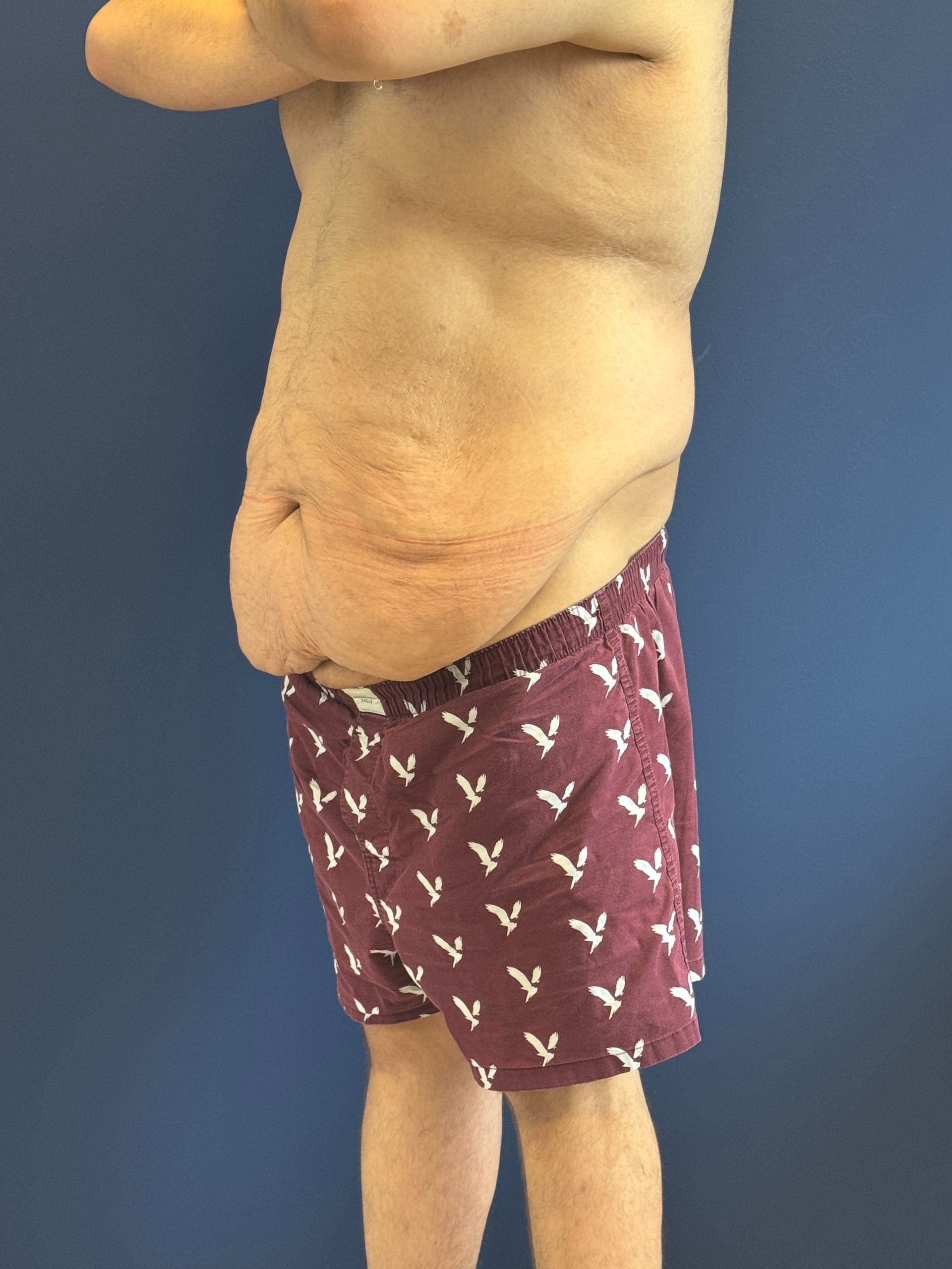 Body-Lift-Case--1927 | Before Body Lift 5