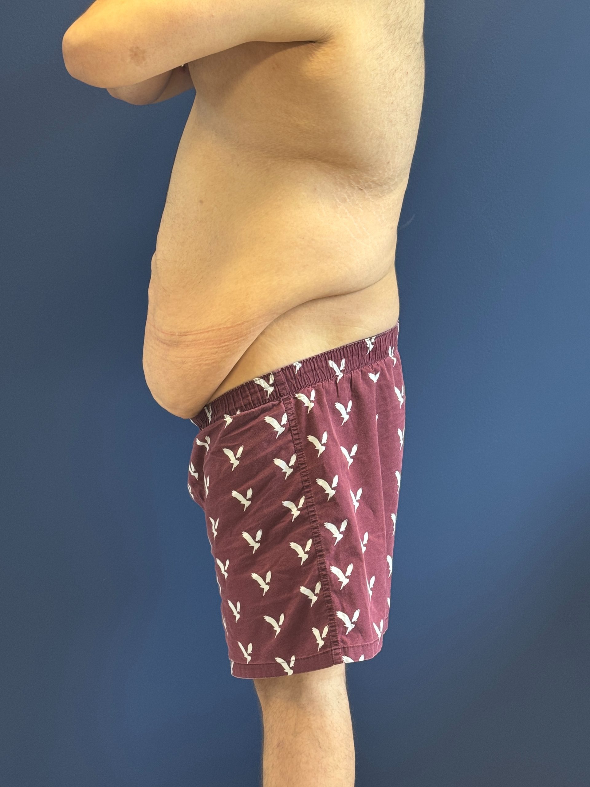 Body-Lift-Case--1927 | Before Body Lift 3