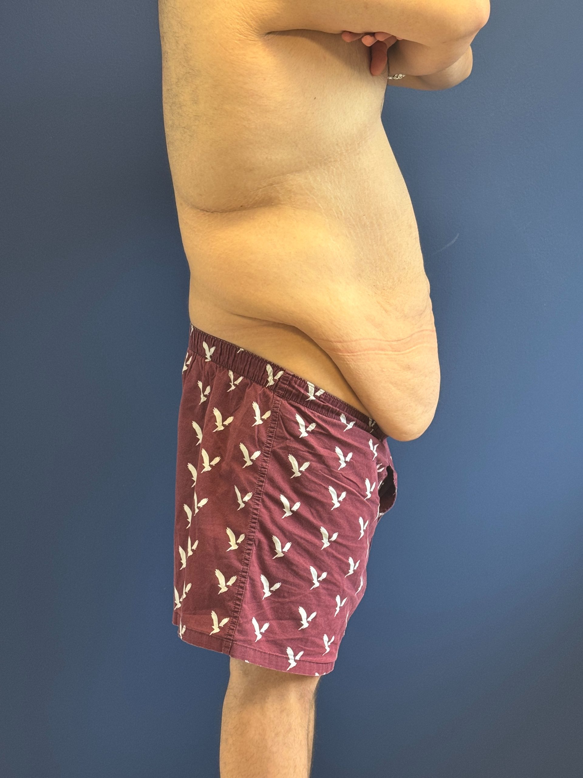 Body-Lift-Case--1927 | Before Body Lift 2