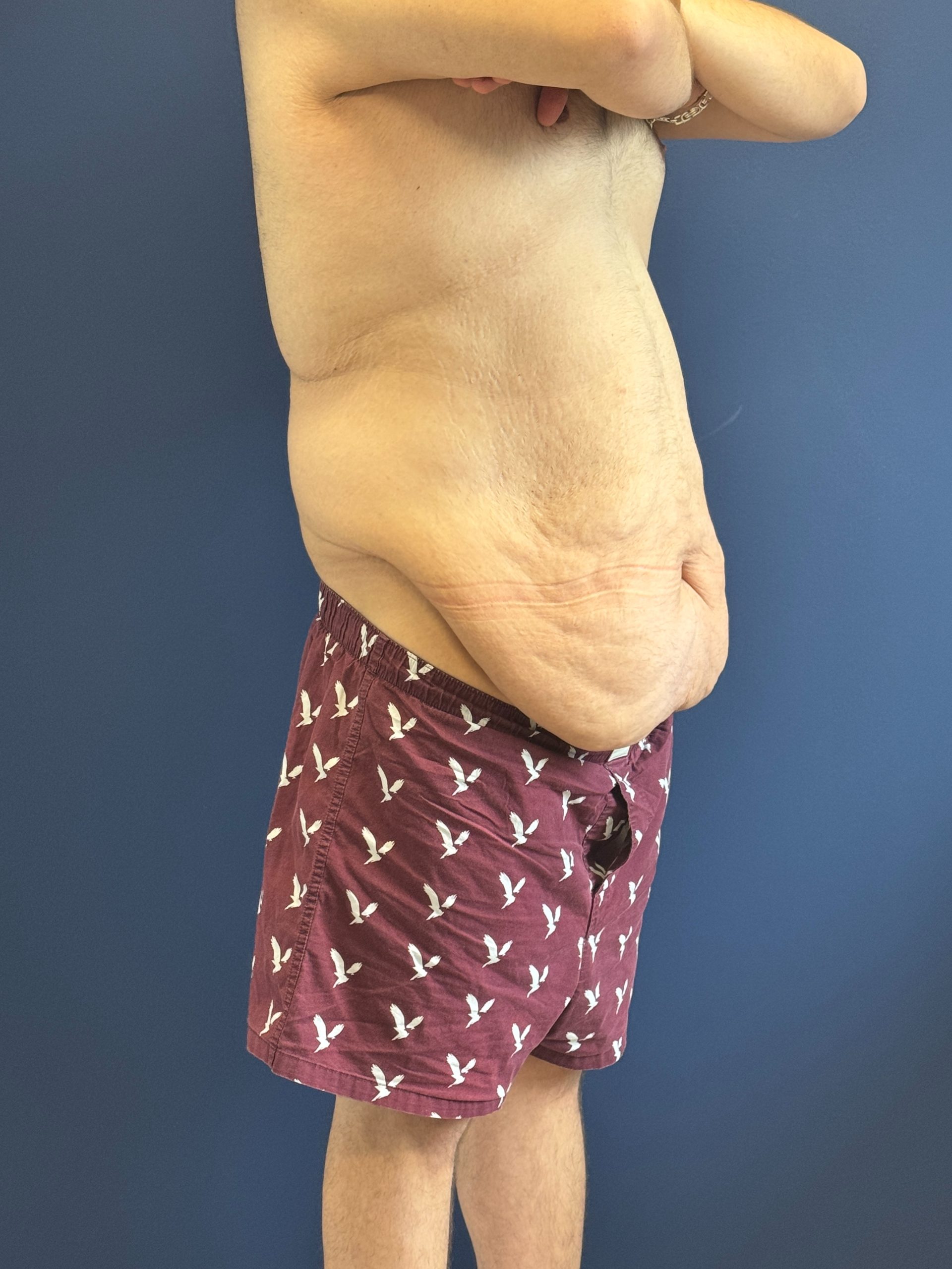 Body-Lift-Case--1927 | Before Body Lift 4