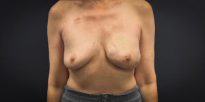 Breast-Reconstruction-Case--5261 | Before Dr. Samir Rao 1