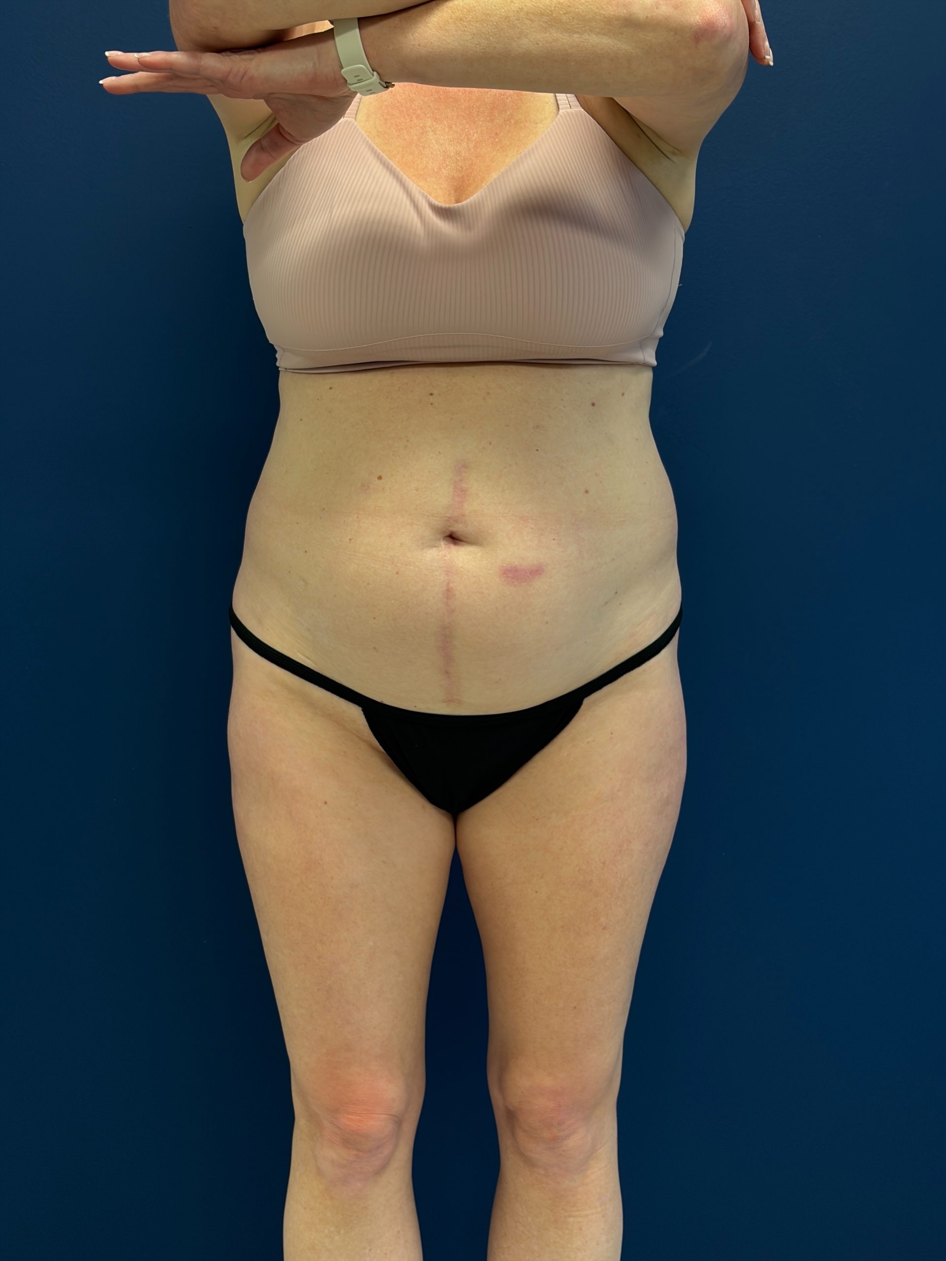 Abdominoplasty-Case--1715 | Before Tummy Tuck 1
