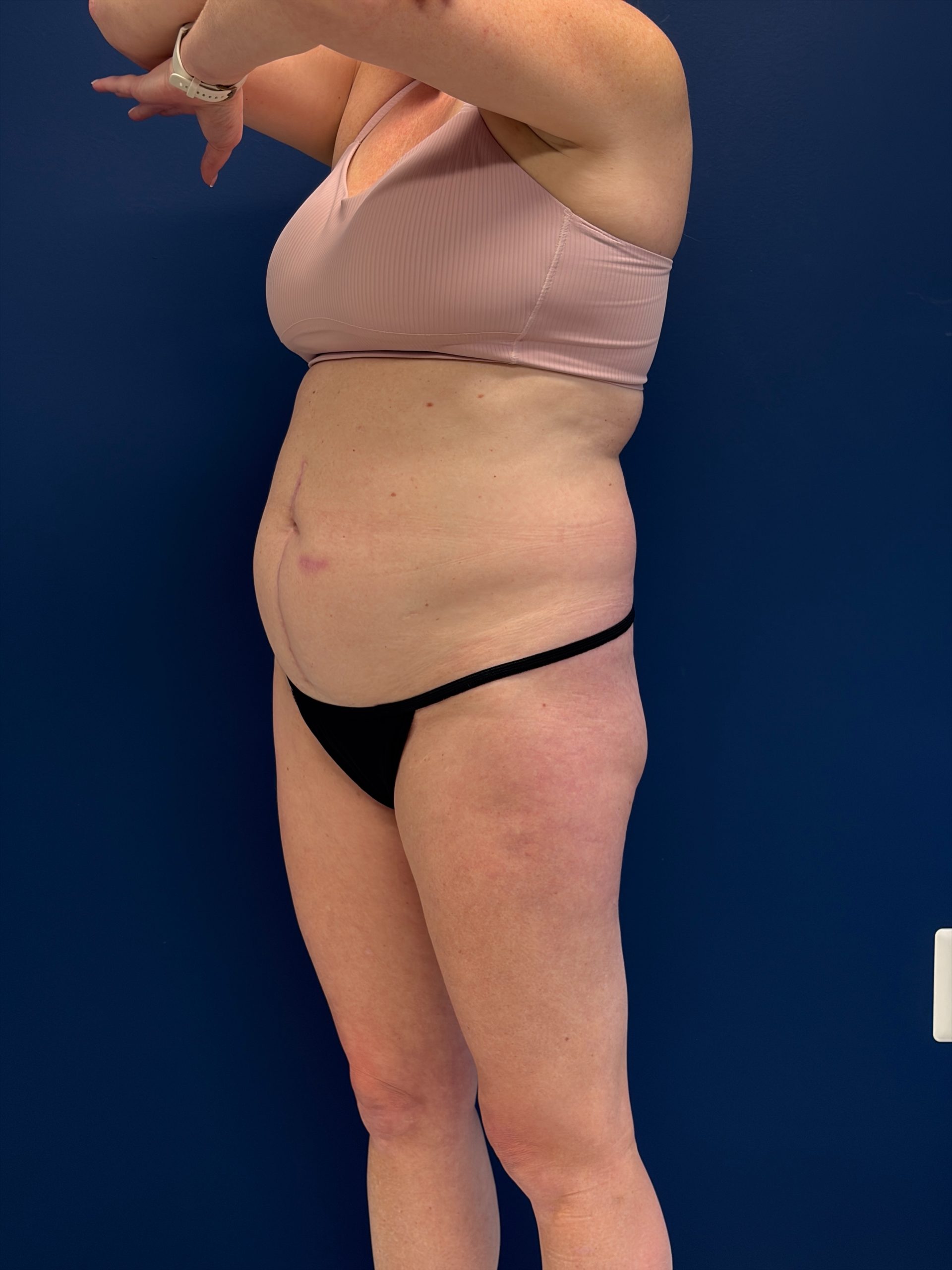 Abdominoplasty-Case--1715 | Before Tummy Tuck 4