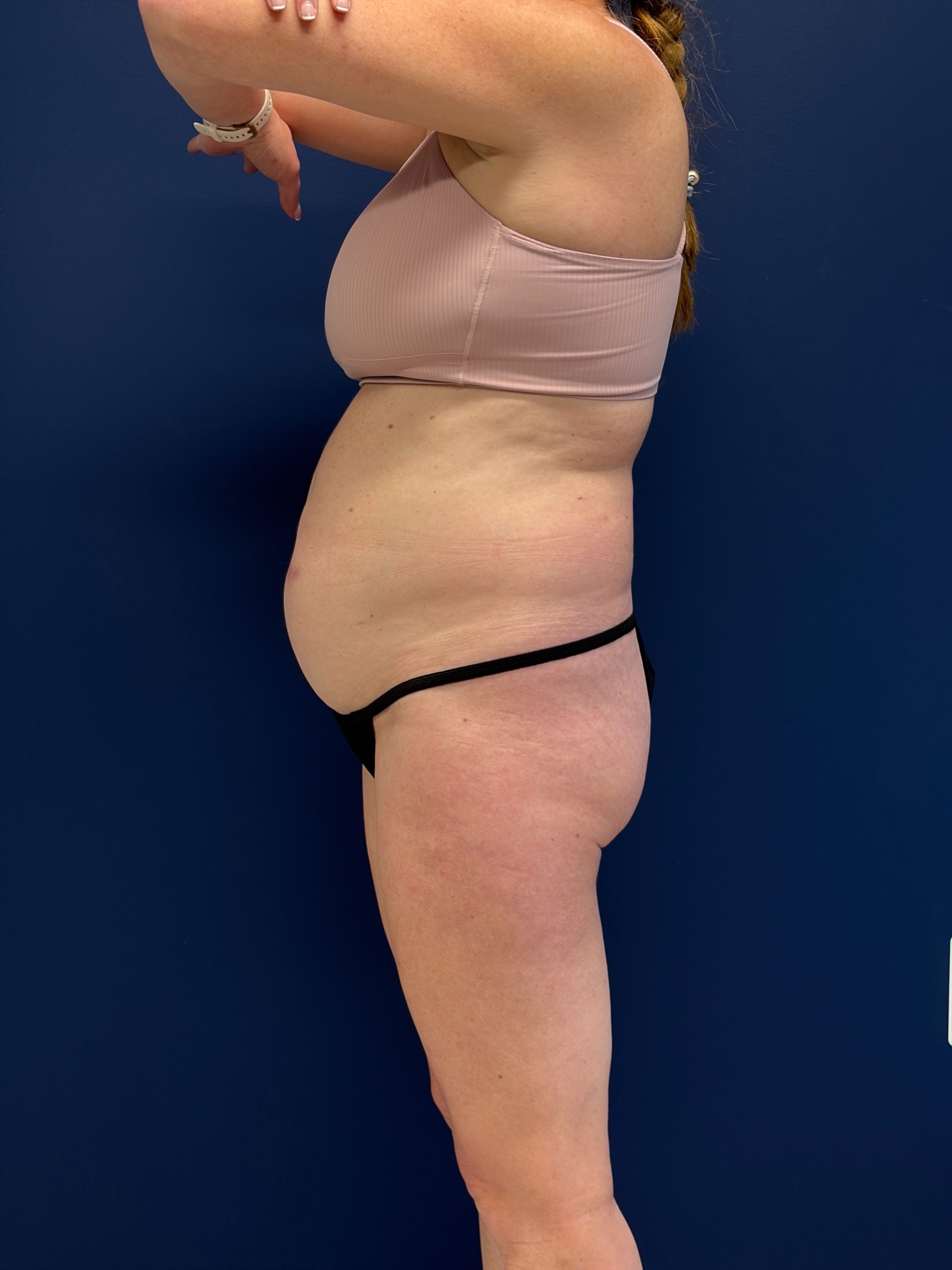 Abdominoplasty-Case--1715 | Before Tummy Tuck 2