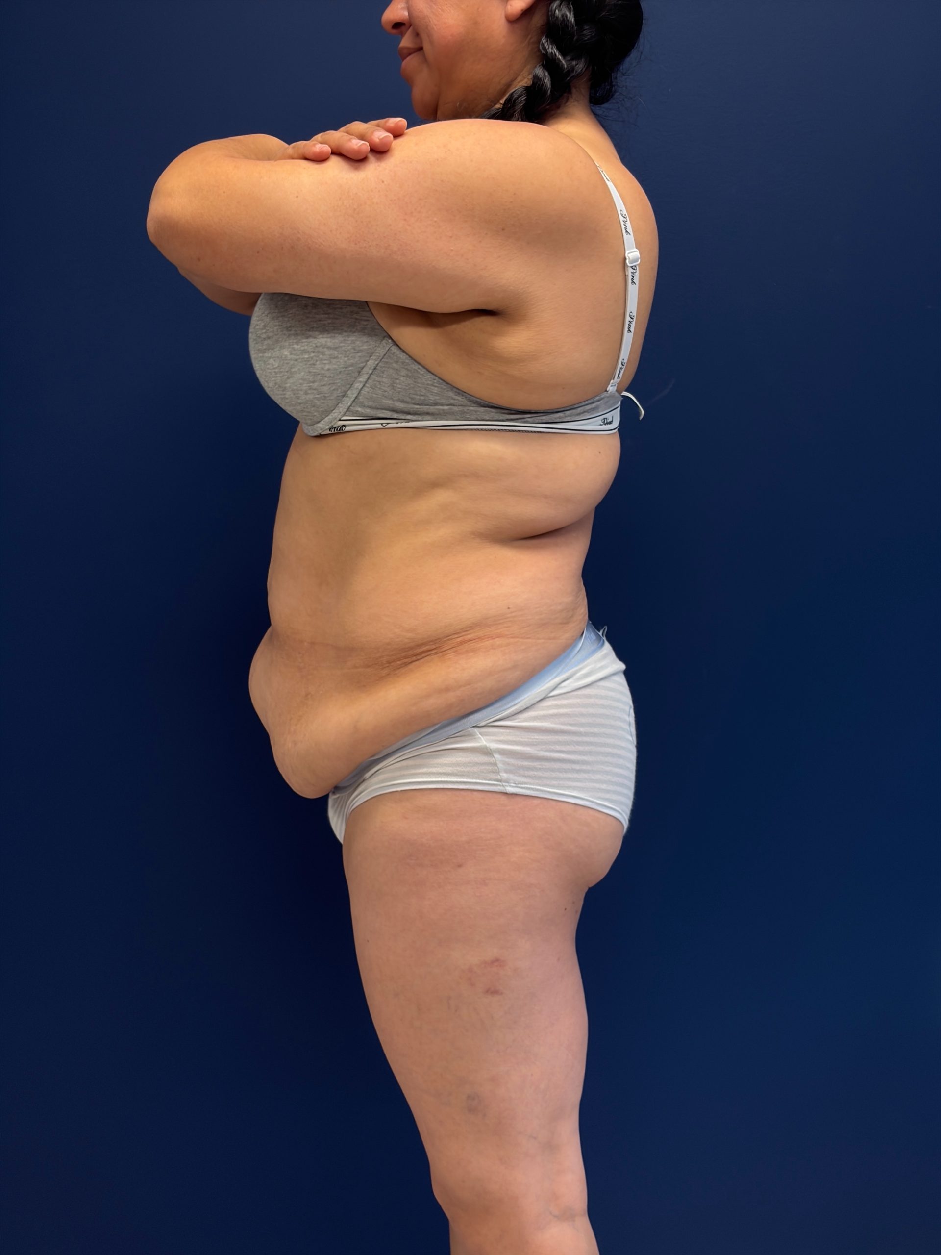 Abdominoplasty-Case--7989 | Before Tummy Tuck 2