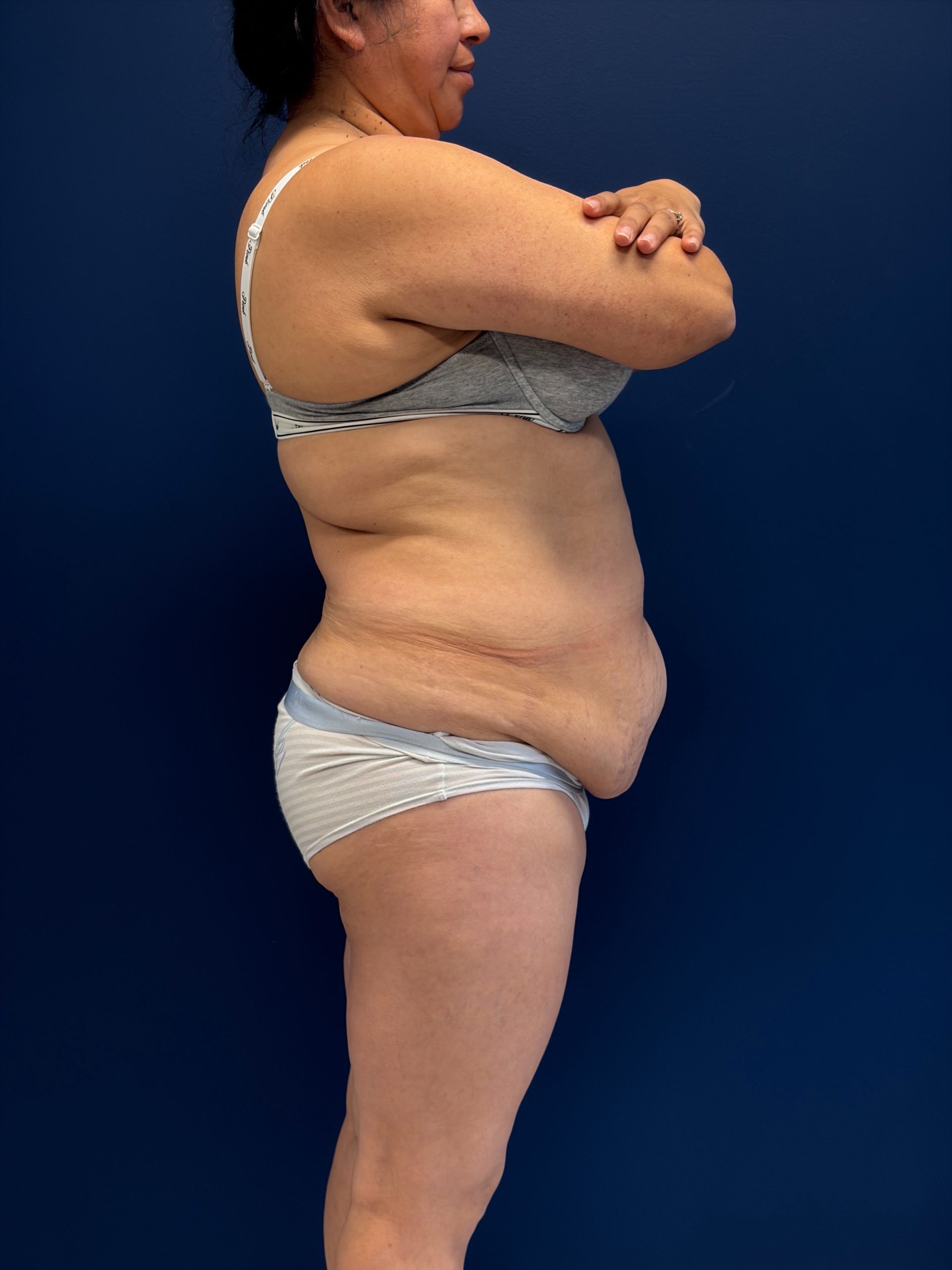 Abdominoplasty-Case--7989 | Before Tummy Tuck 3