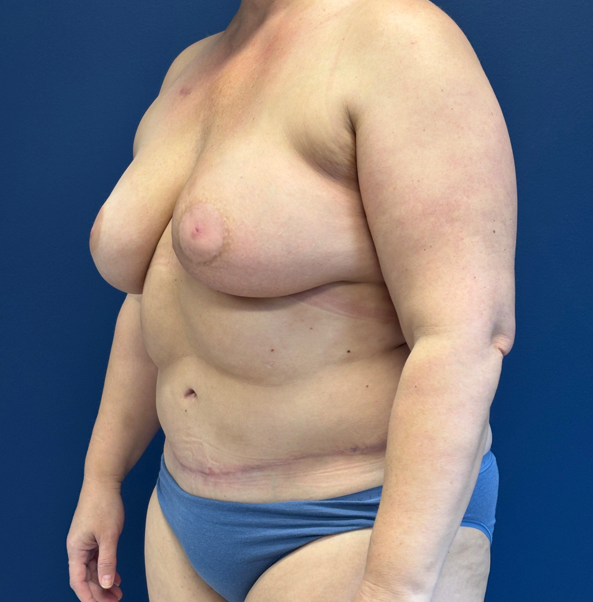 DIEP-Flap-Case--1682 | After DIEP Flap 2