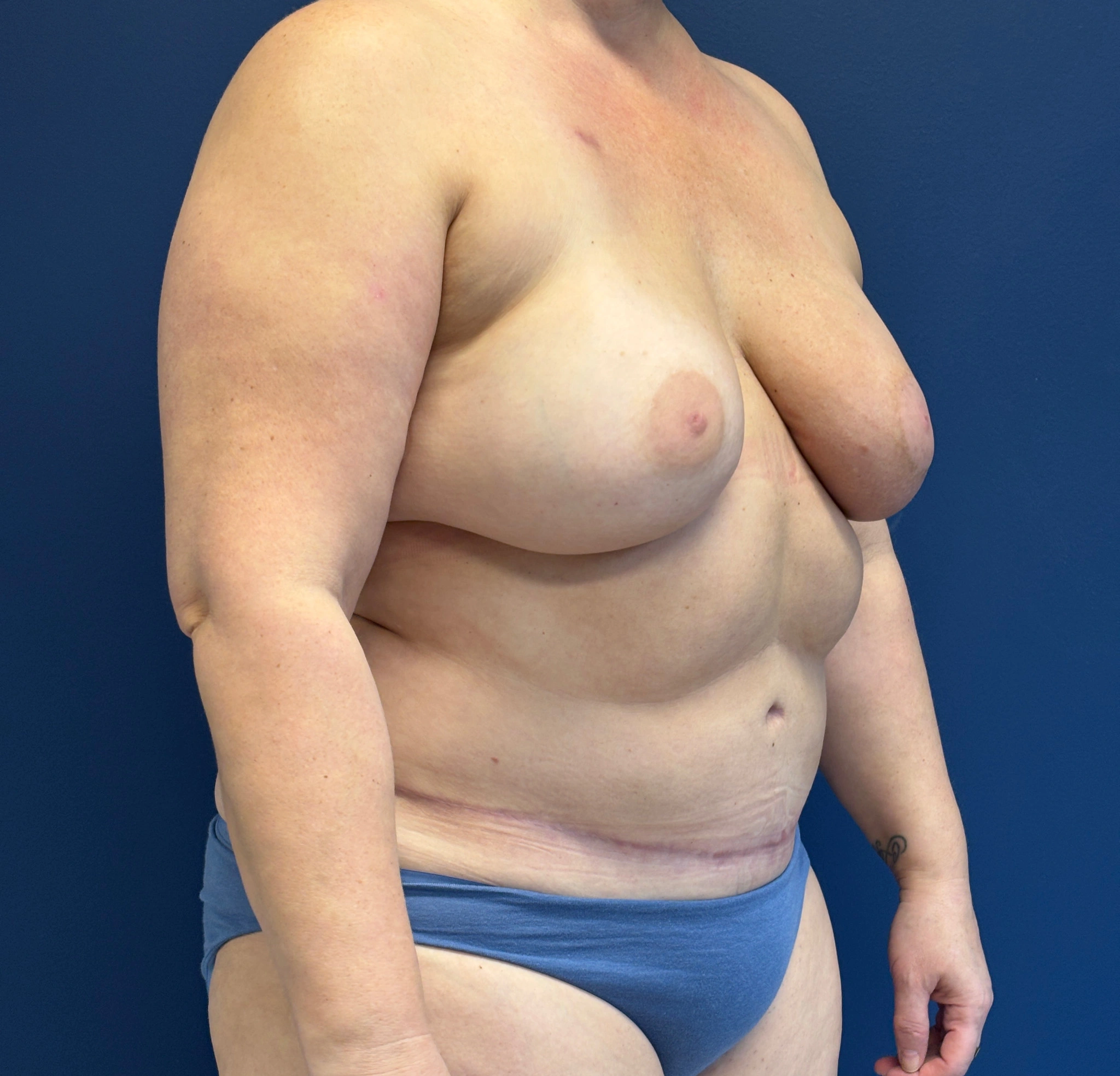 DIEP-Flap-Case--1682 | After DIEP Flap 3