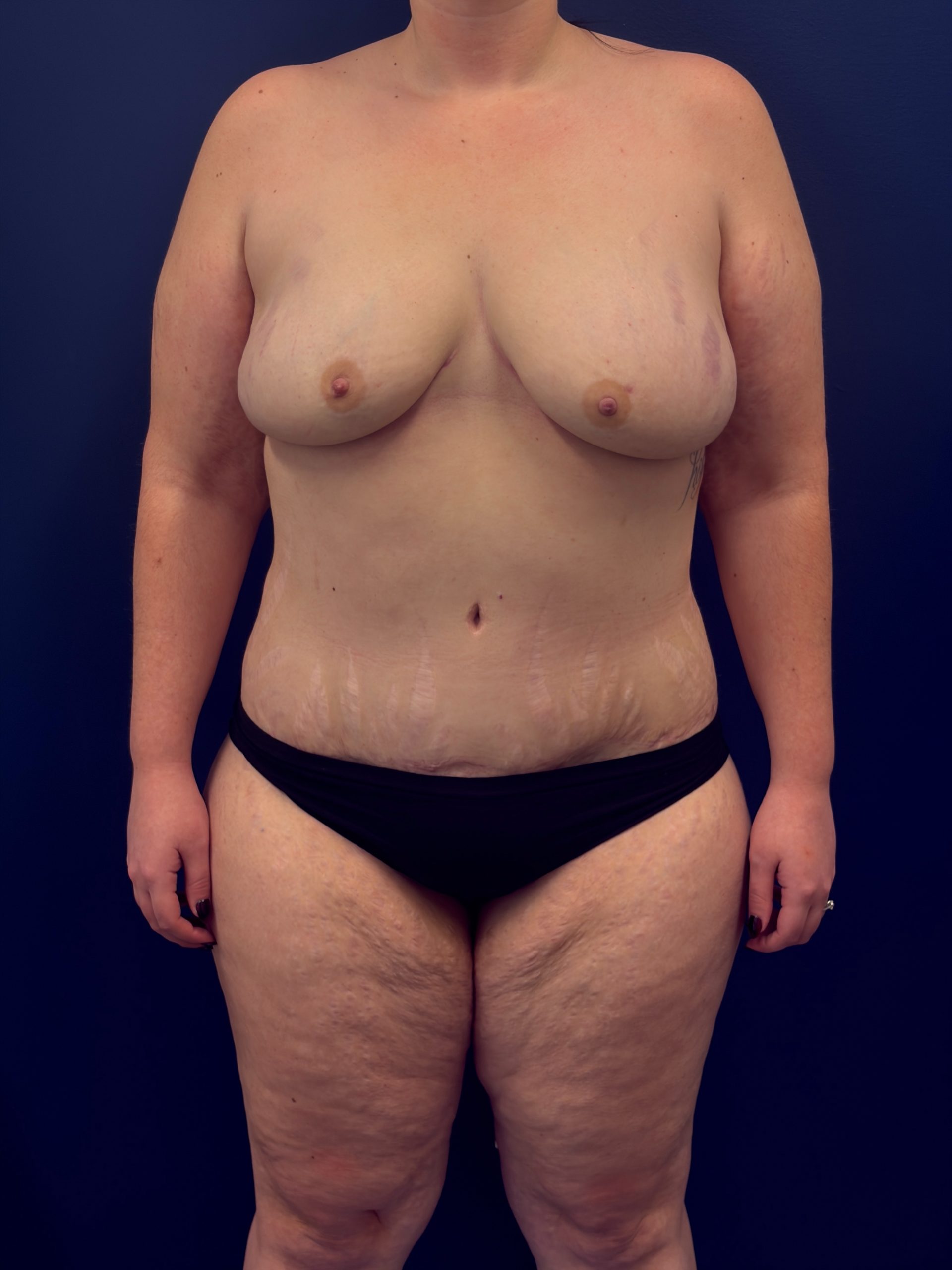 Bilateral-DIEP-Flap-Case--1108 | After DIEP Flap 1