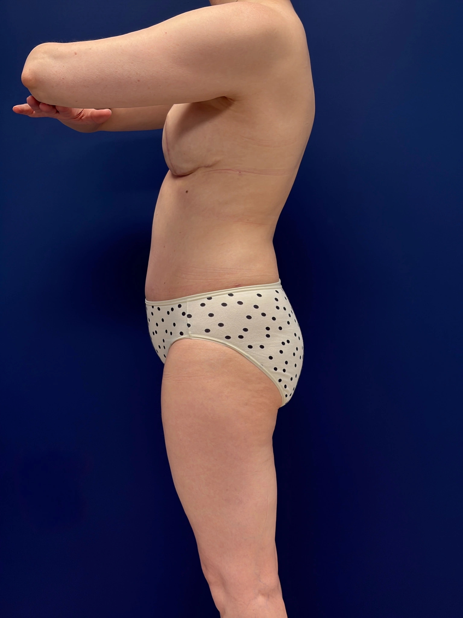 Abdominoplasty-Case--4180 | After Tummy Tuck 2