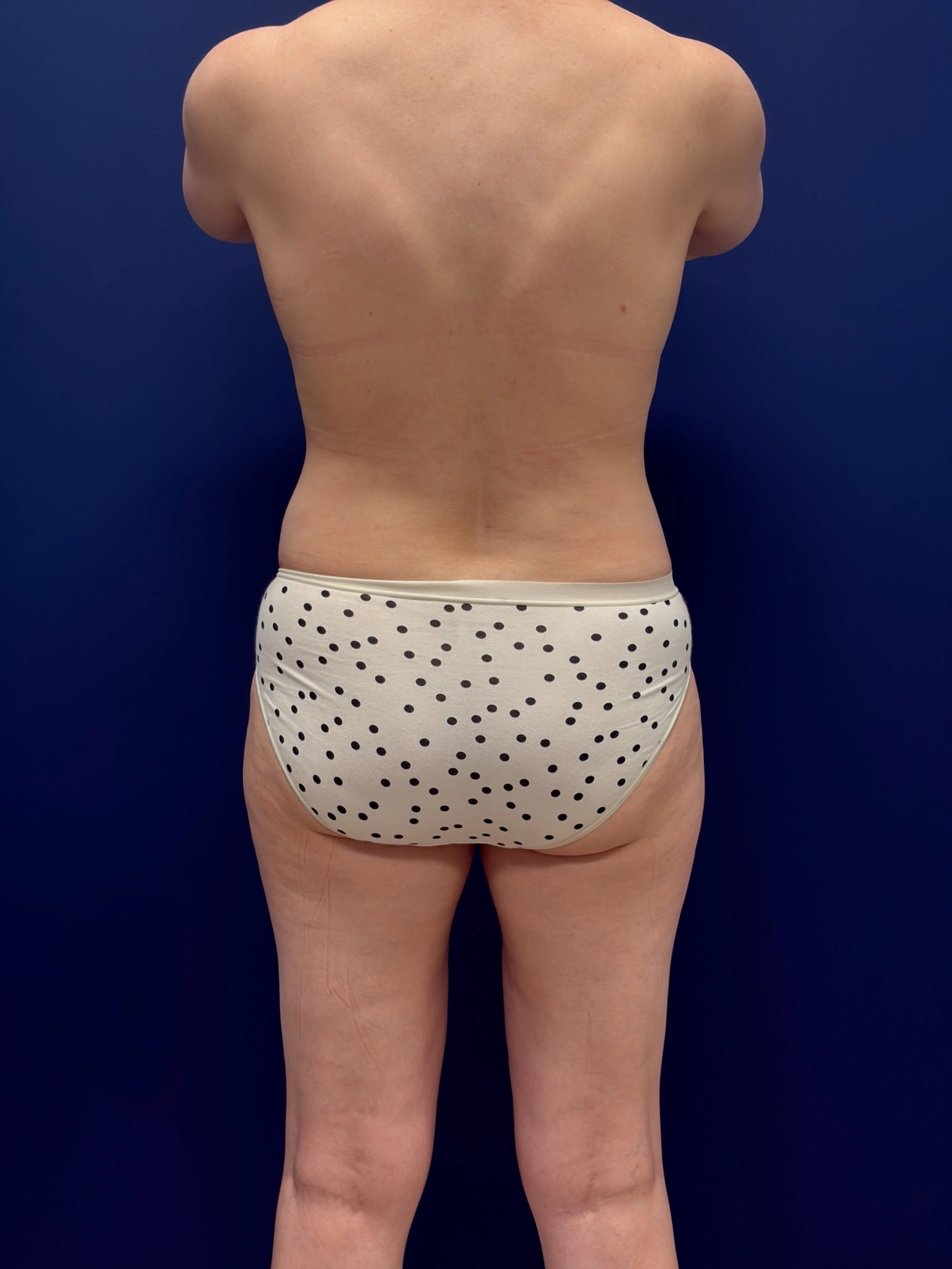 Abdominoplasty-Case--4180 | After Tummy Tuck 6