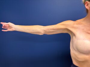 Brachioplasty-Case--3898 | After Arm Lift 1