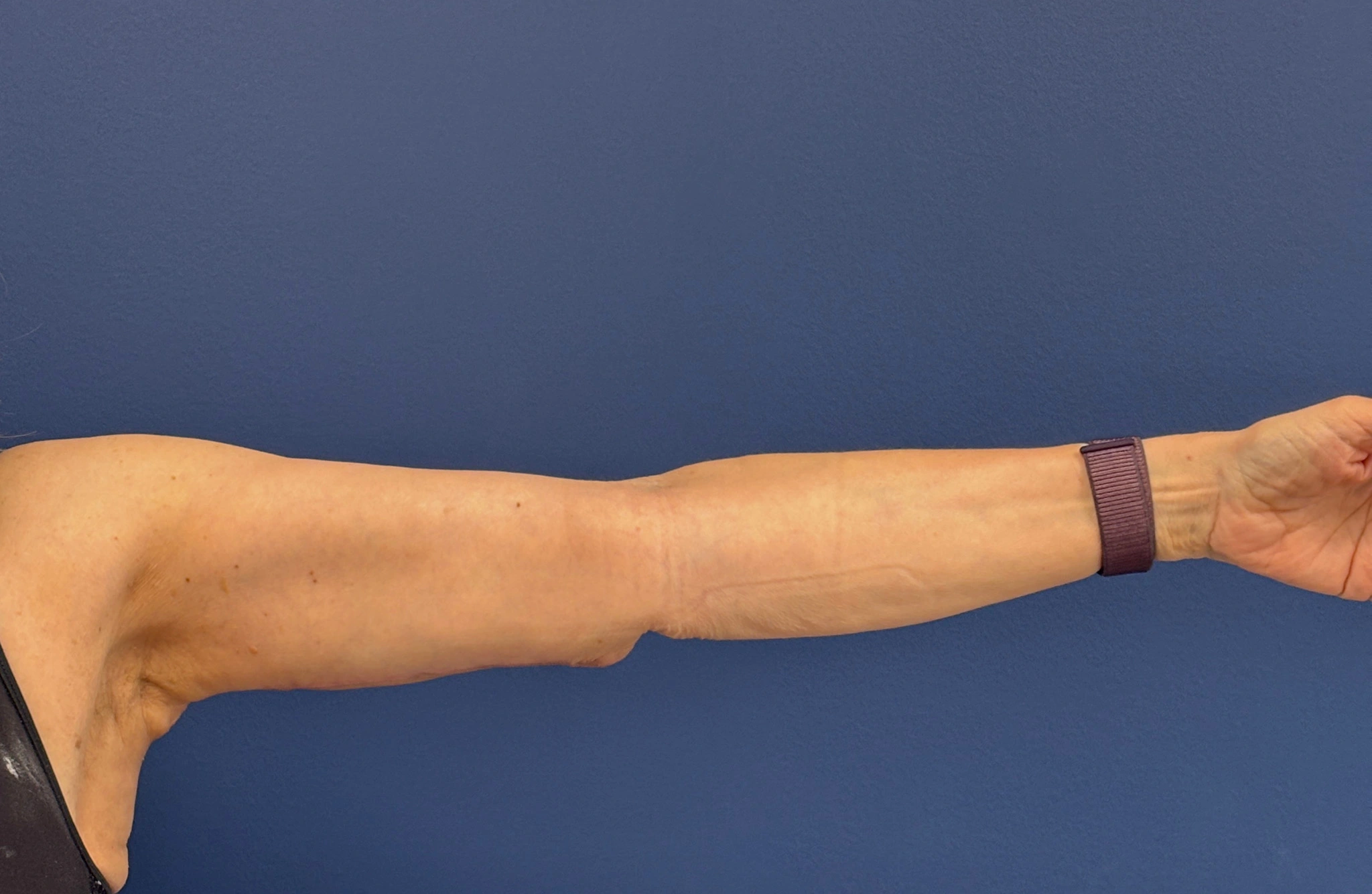 Brachioplasty-Case--3625 | After Arm Lift 5