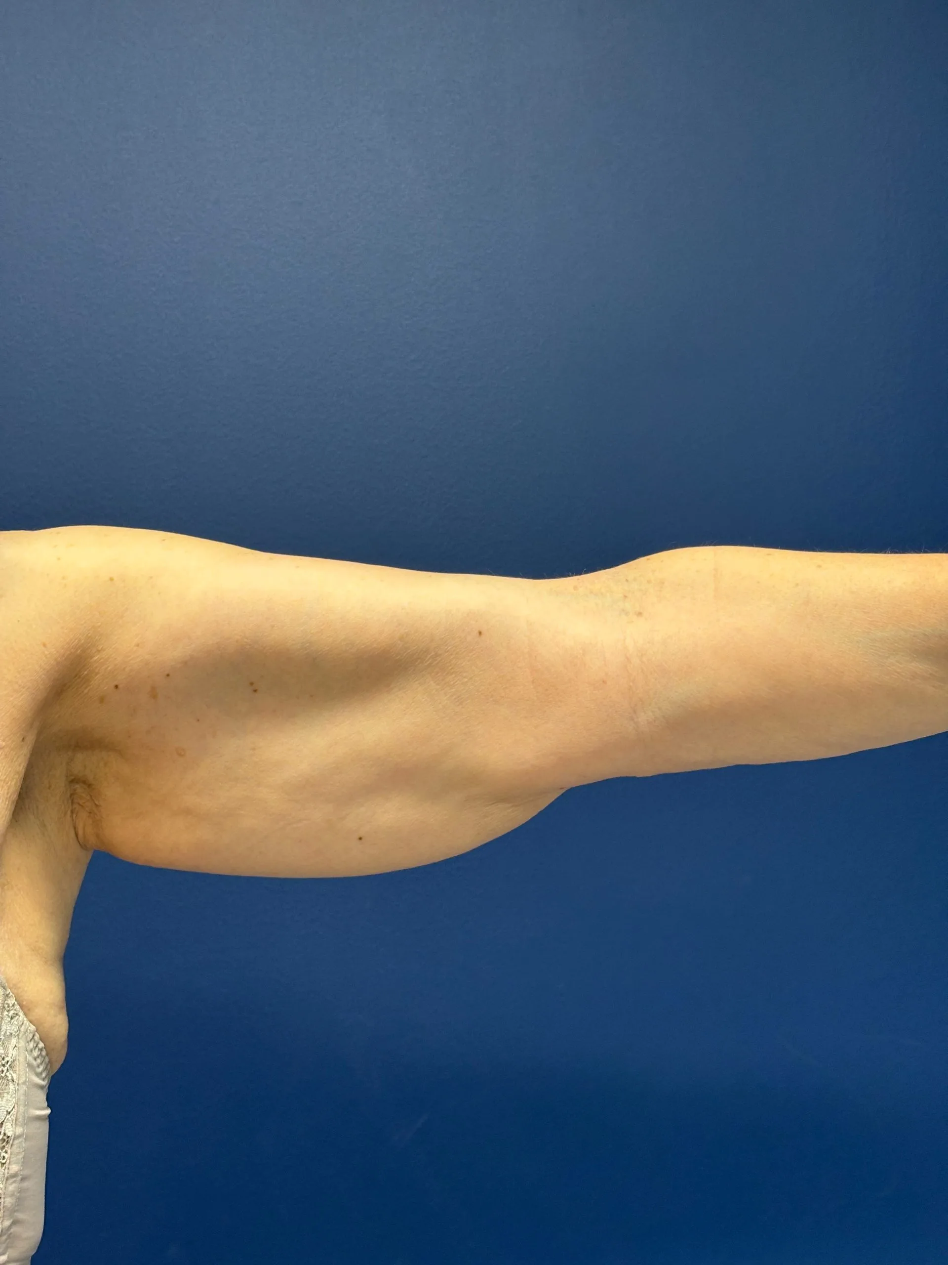 Brachioplasty-Case--3625 | Before Arm Lift 5
