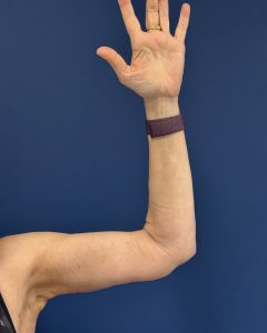 Brachioplasty-Case--3625 | After Arm Lift 1