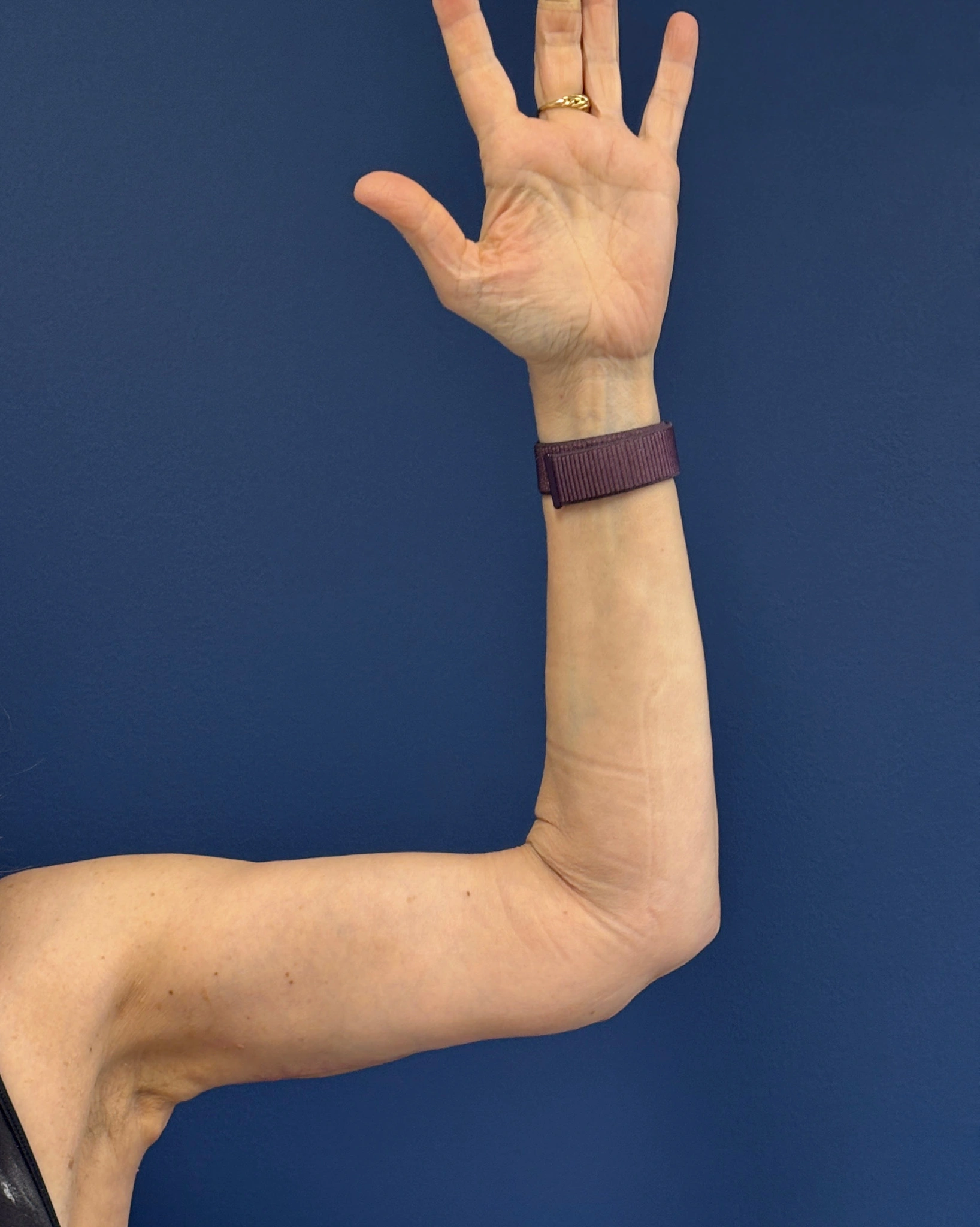 Brachioplasty-Case--3625 | After Arm Lift 1