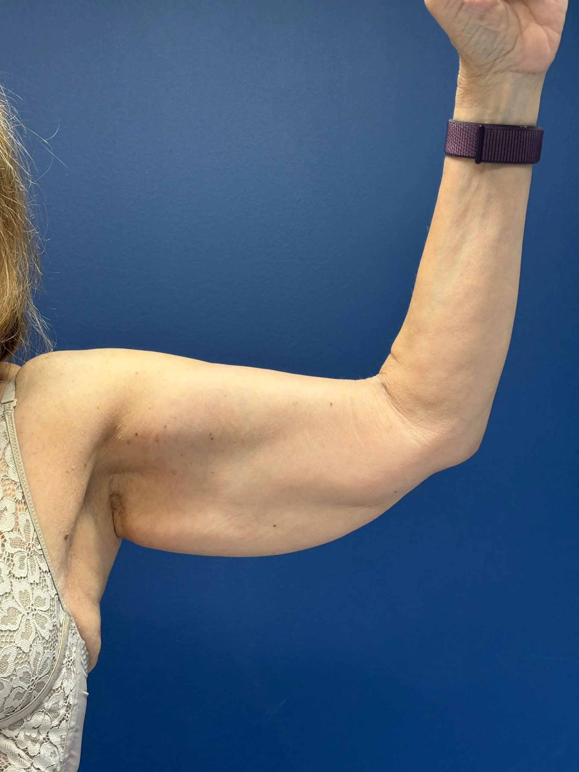 Brachioplasty-Case--3625 | Before Arm Lift 1