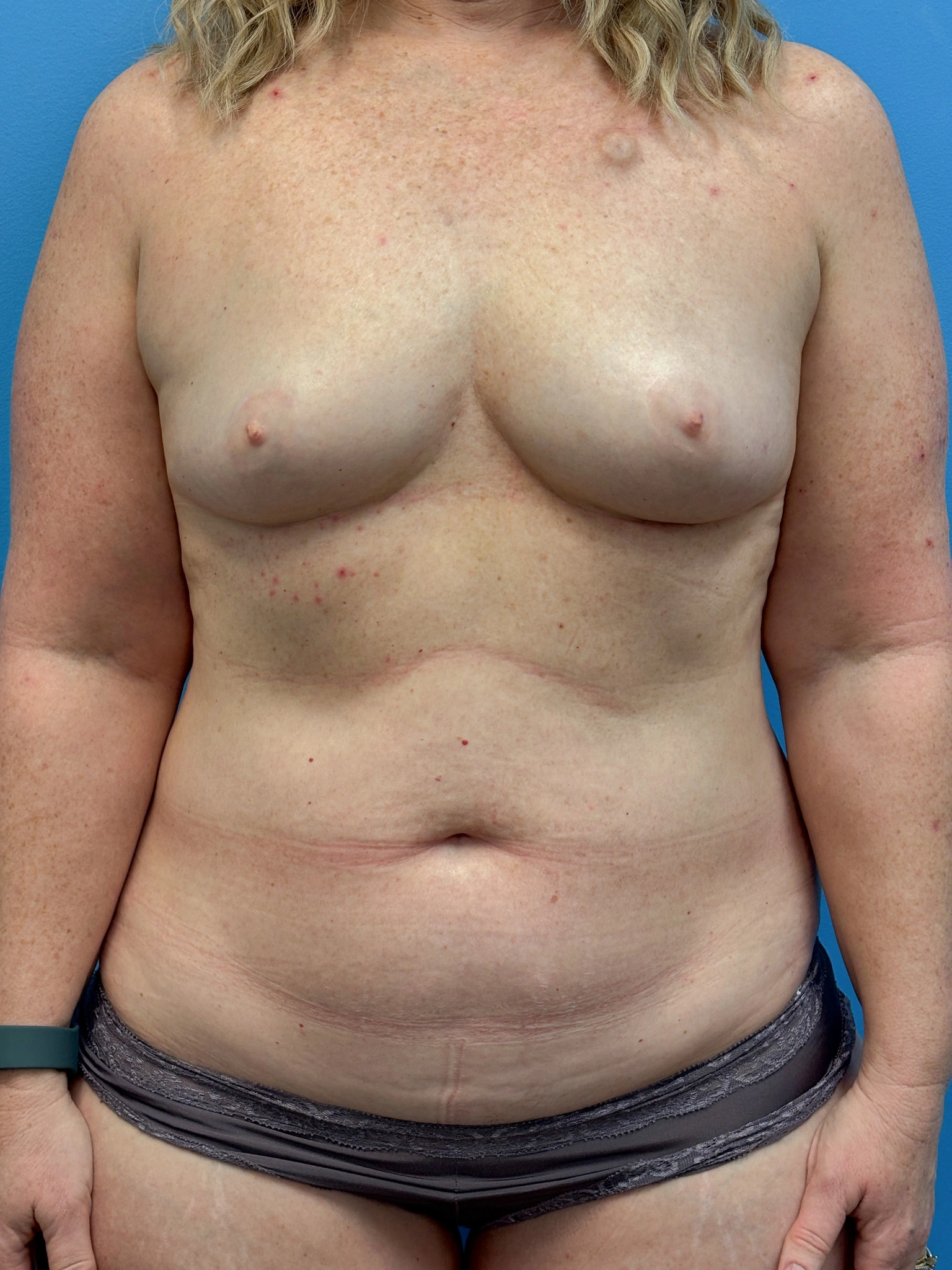 DIEP-Flap-Case--3138 | Before DIEP Flap 1