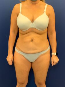 Abdominoplasty-Case--7924 | Before Dr. Frank Albino 1