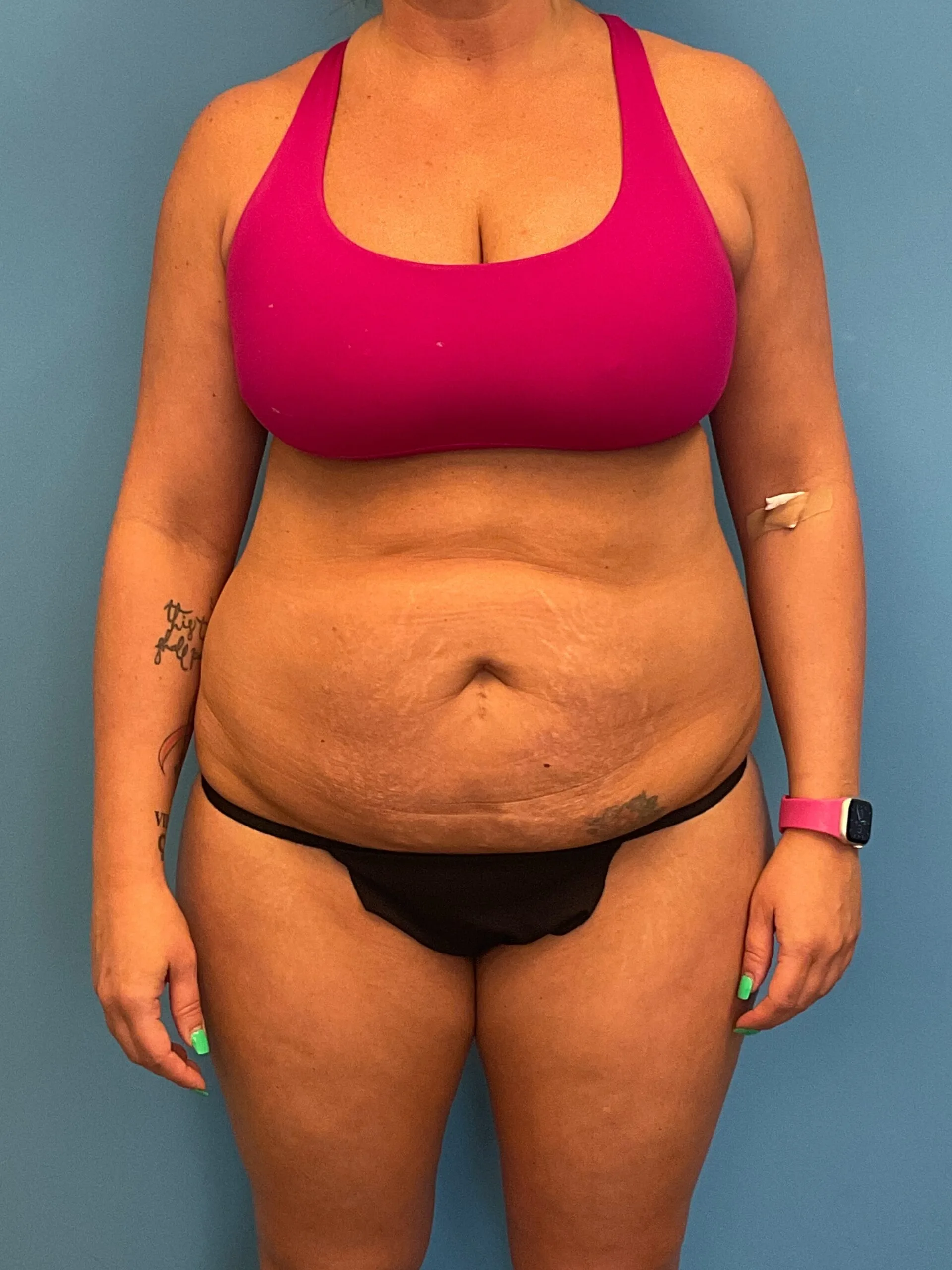 Abdominoplasty-Case--3117 | Before Tummy Tuck 1