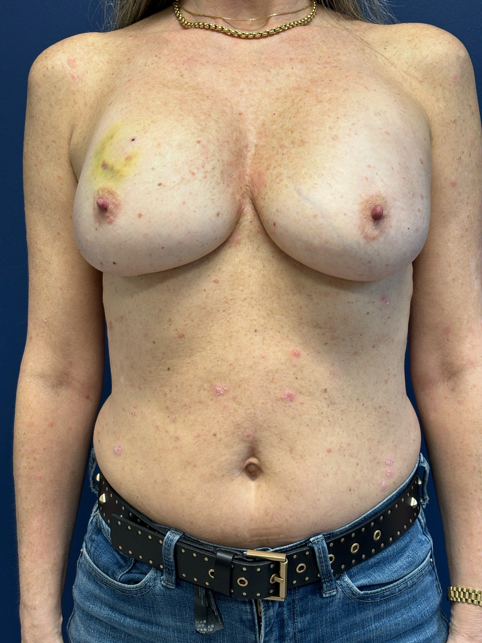 Breast-Reconstruction-Case--8978 | Before Breast Reconstruction 1