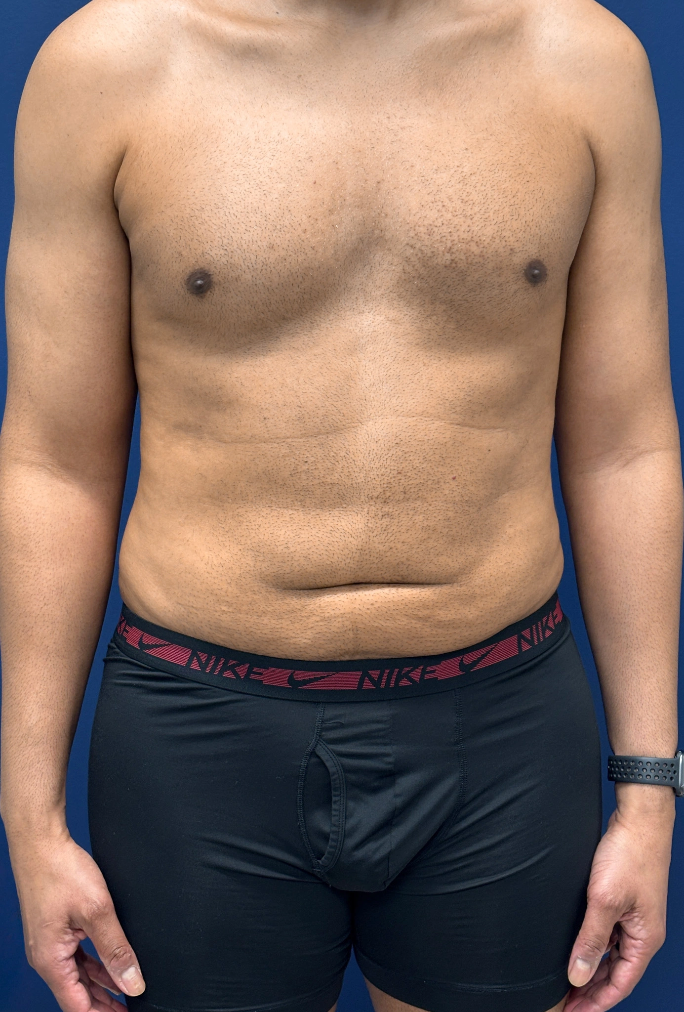 Lipo-360-Case--4979 | After Liposuction 1