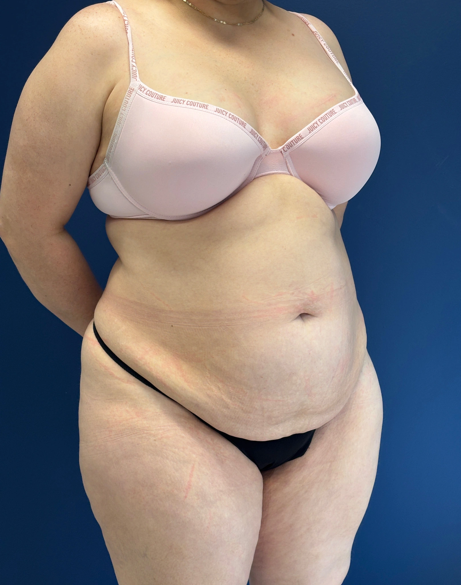 Abdominoplasty-Case--1259 | Before Tummy Tuck 4