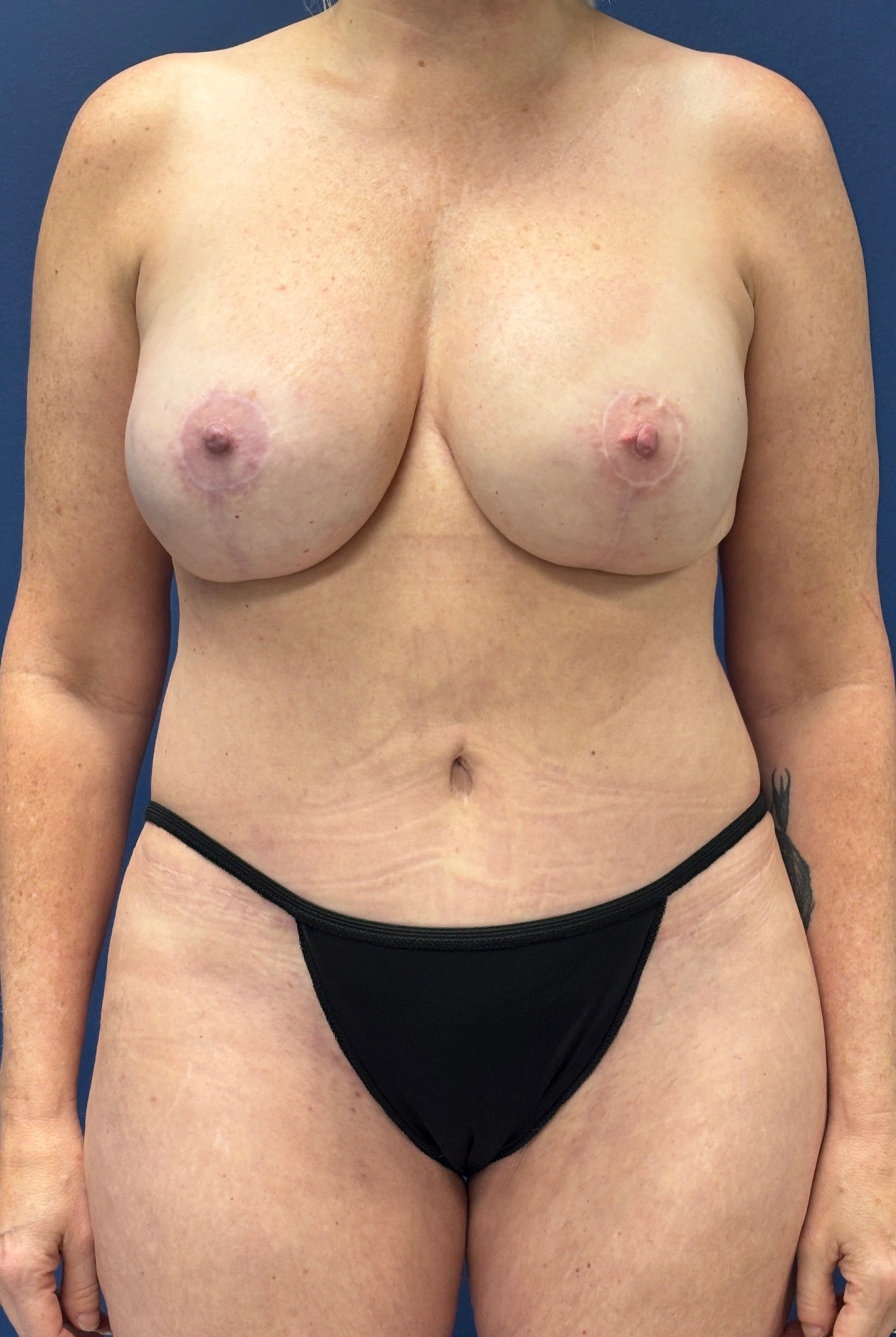 DIEP-Flap-Case--2056 | After DIEP Flap 1