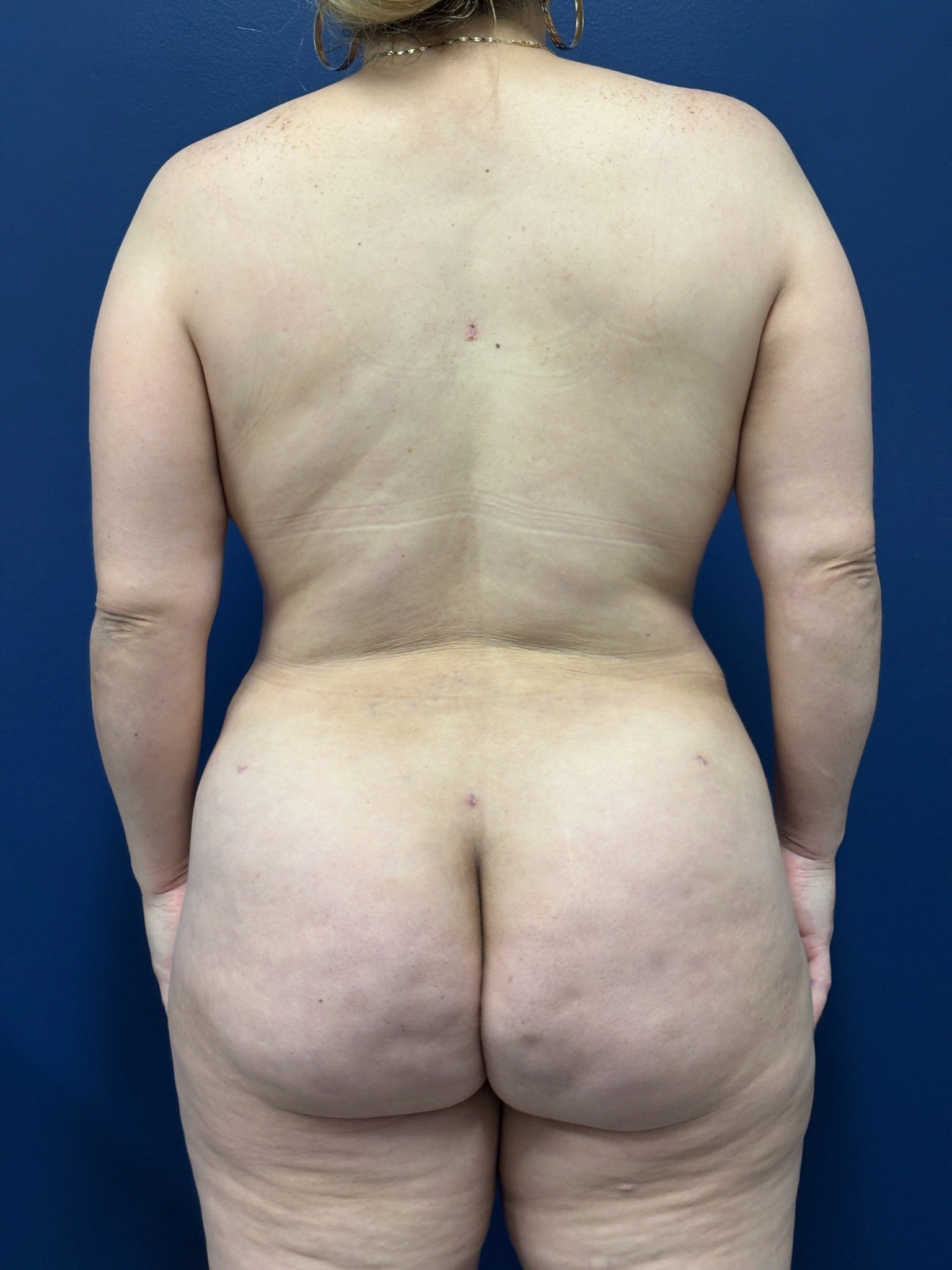 Brazilian-Butt-Lift-Case--9569 | After Brazilian Butt Lift 1