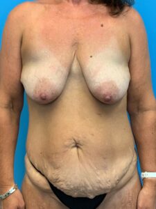 Abdominoplasty-Case--7009 | Before Dr. Frank Albino 1