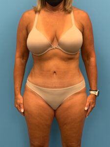 Abdominoplasty-Case--7924 | After Dr. Frank Albino 1
