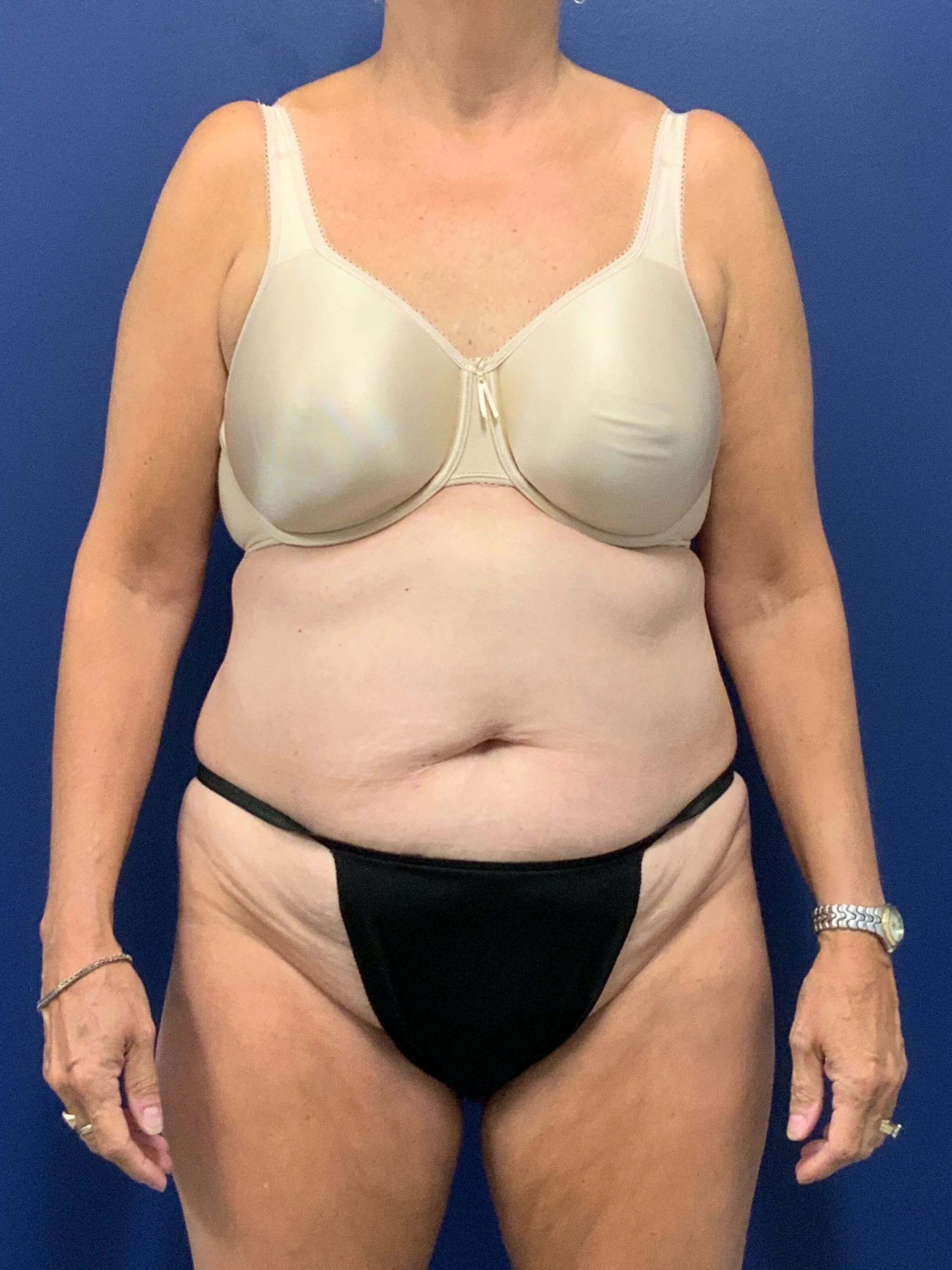 Abdominoplasty-Case--7963 | Before Tummy Tuck 1