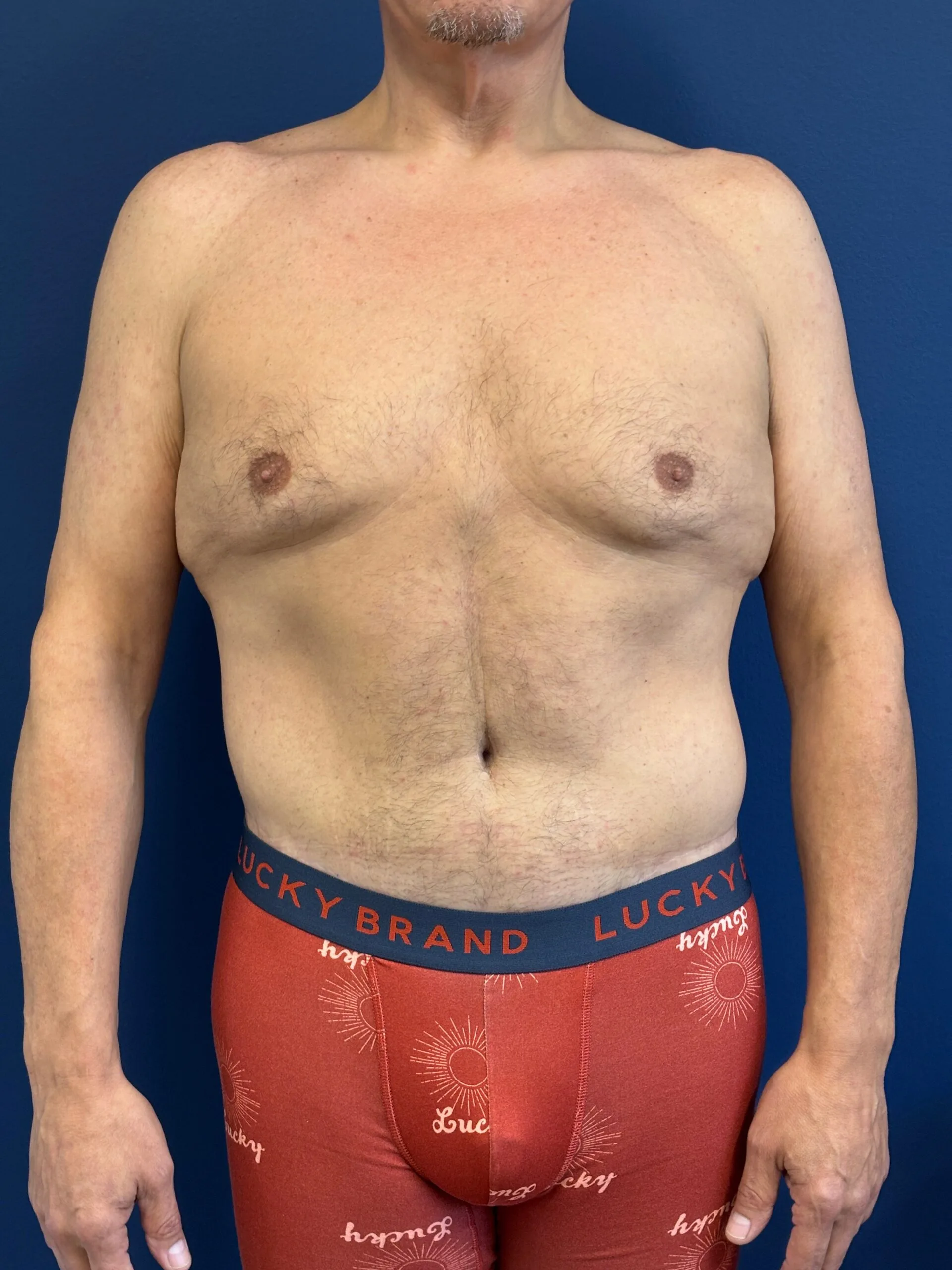 Abdominoplasty-Case--2524 | After Tummy Tuck 1