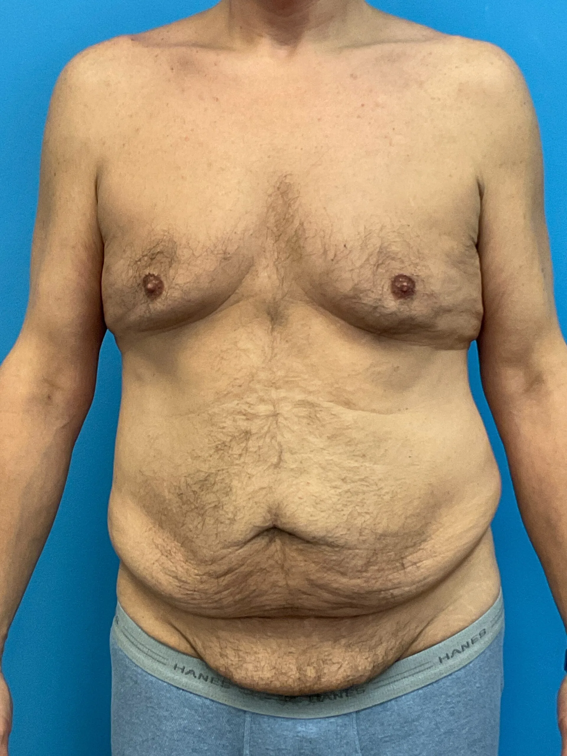 Abdominoplasty-Case--2524 | Before Tummy Tuck 1
