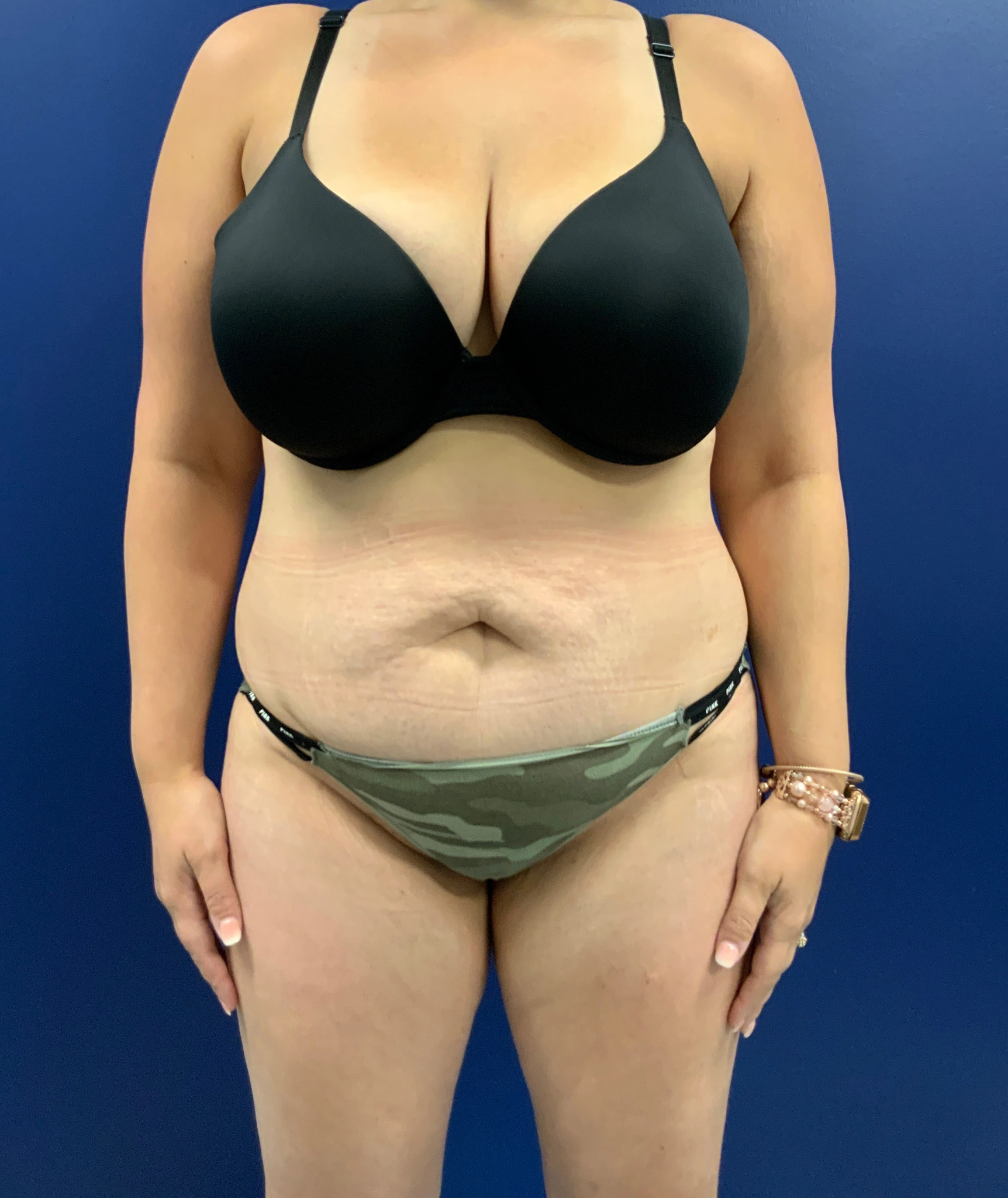 Abdominoplasty-Case--3073 | Before Tummy Tuck 1