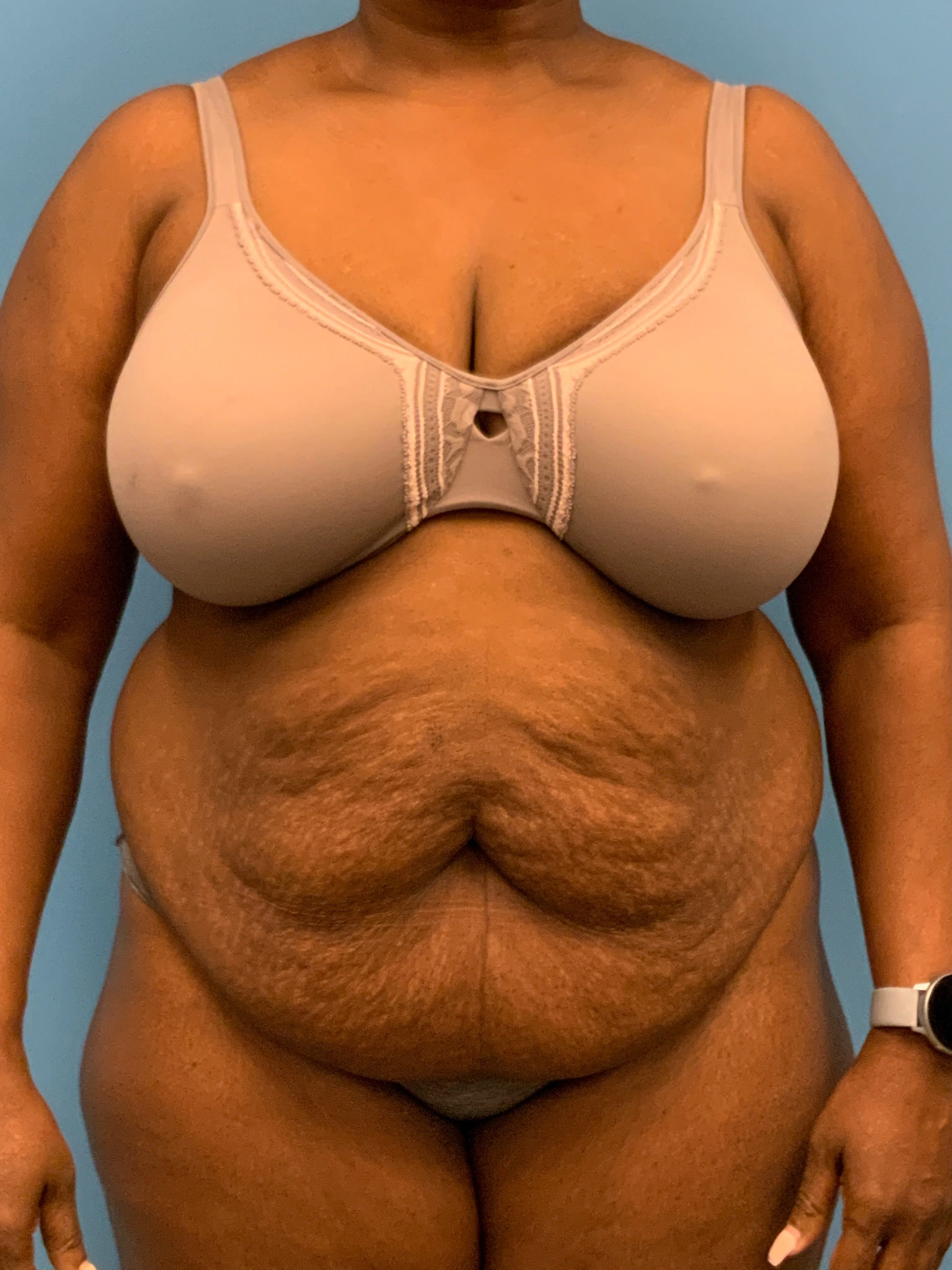 Abdominoplasty-Case--5907 | Before Tummy Tuck 1