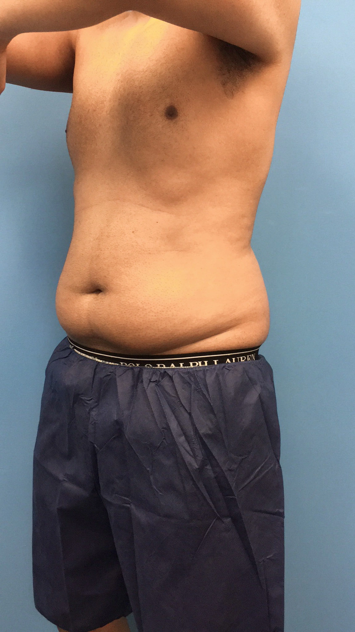 Lipo-360-Case--4979 | Before Liposuction 5