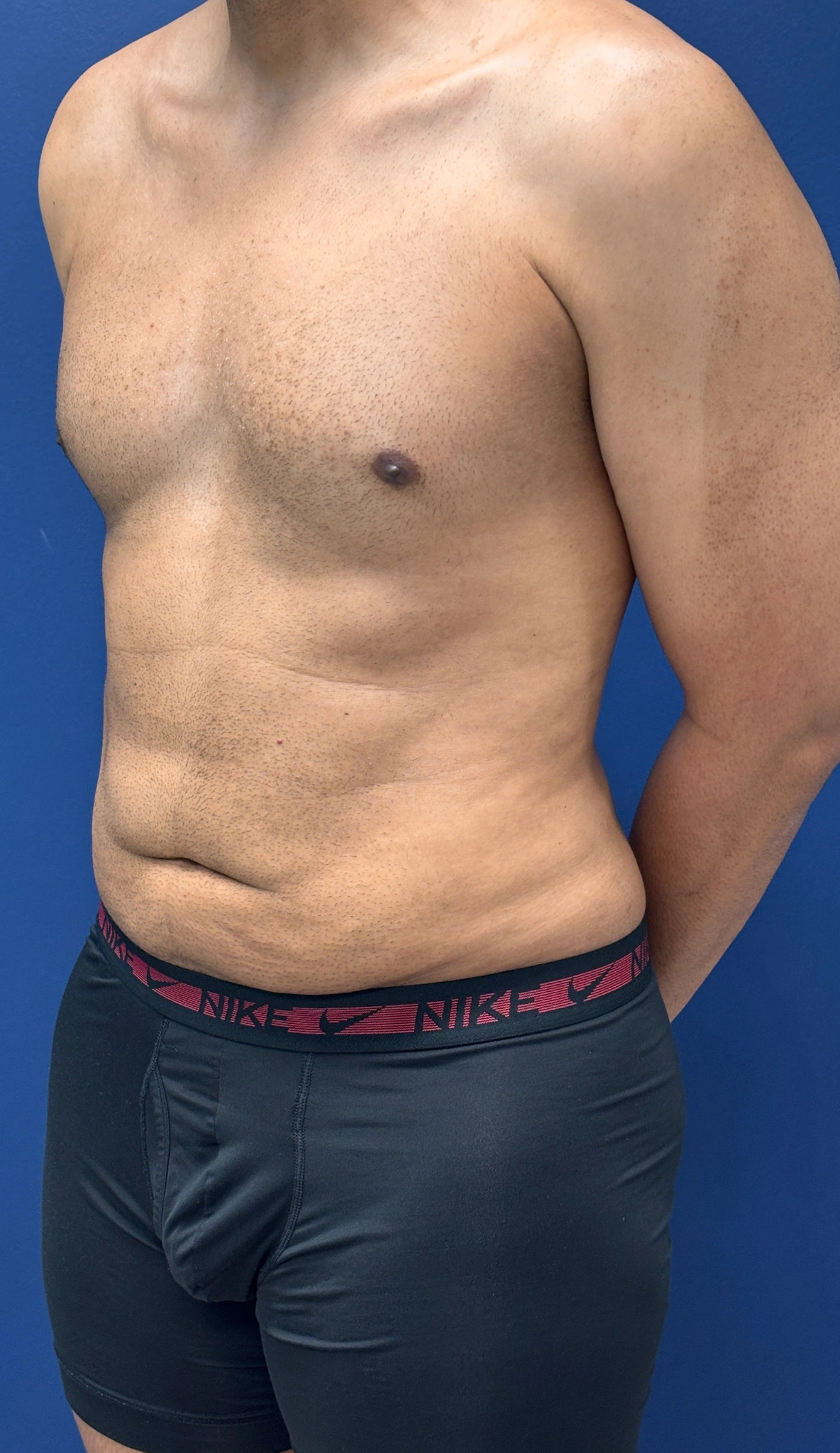 Lipo-360-Case--4979 | After Liposuction 5