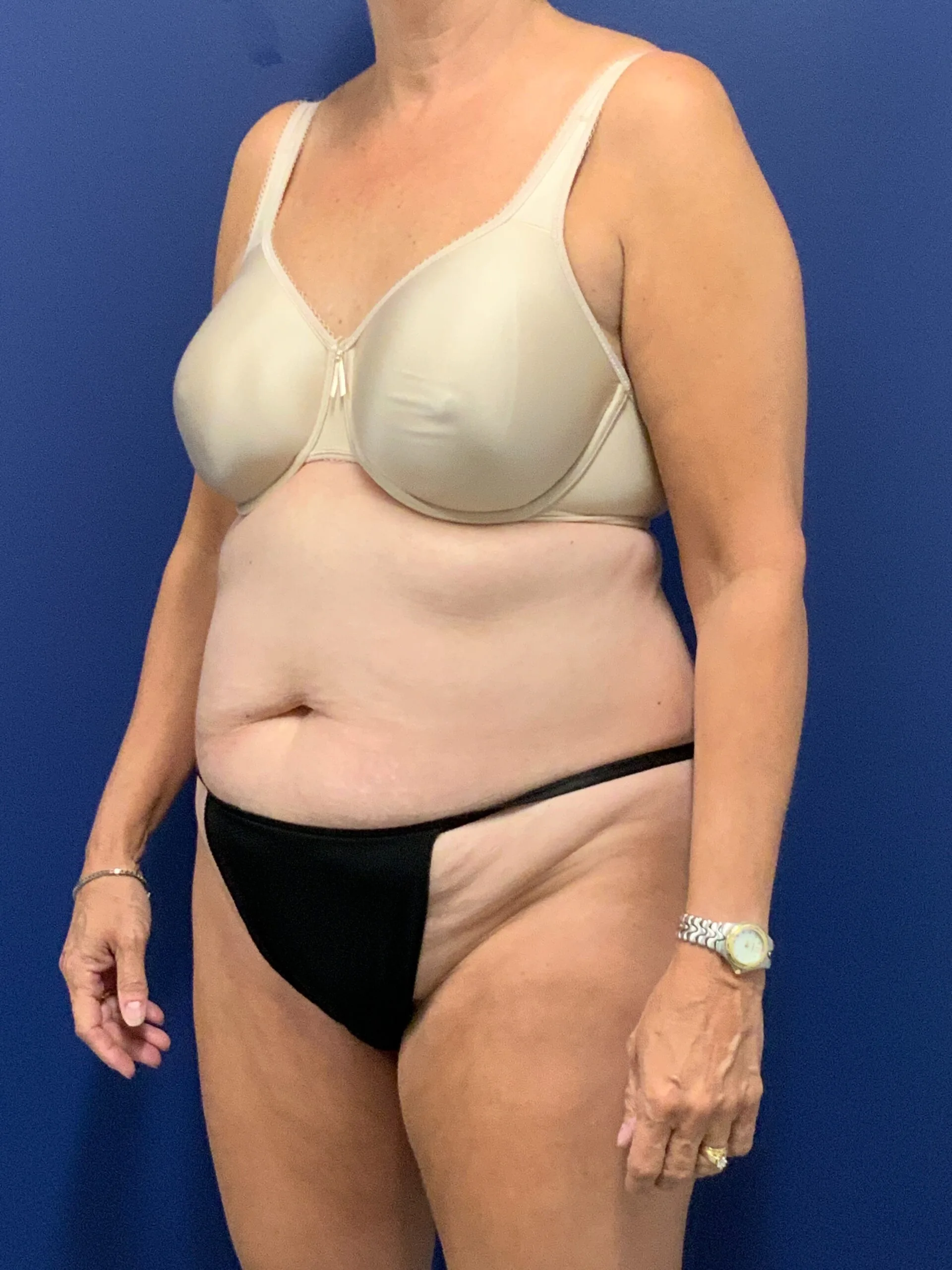 Abdominoplasty-Case--7963 | Before Tummy Tuck 2