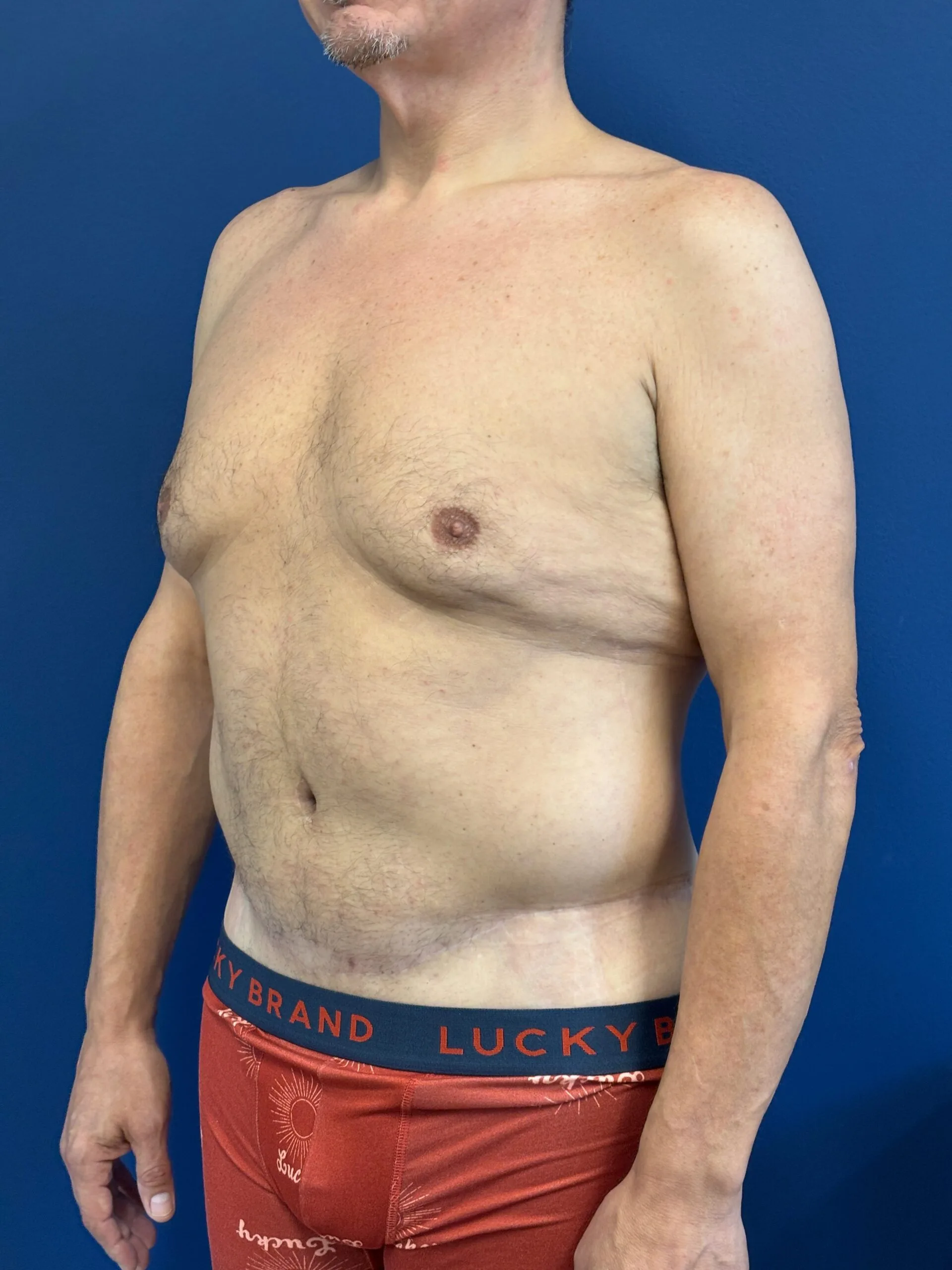 Abdominoplasty-Case--2524 | After Tummy Tuck 2