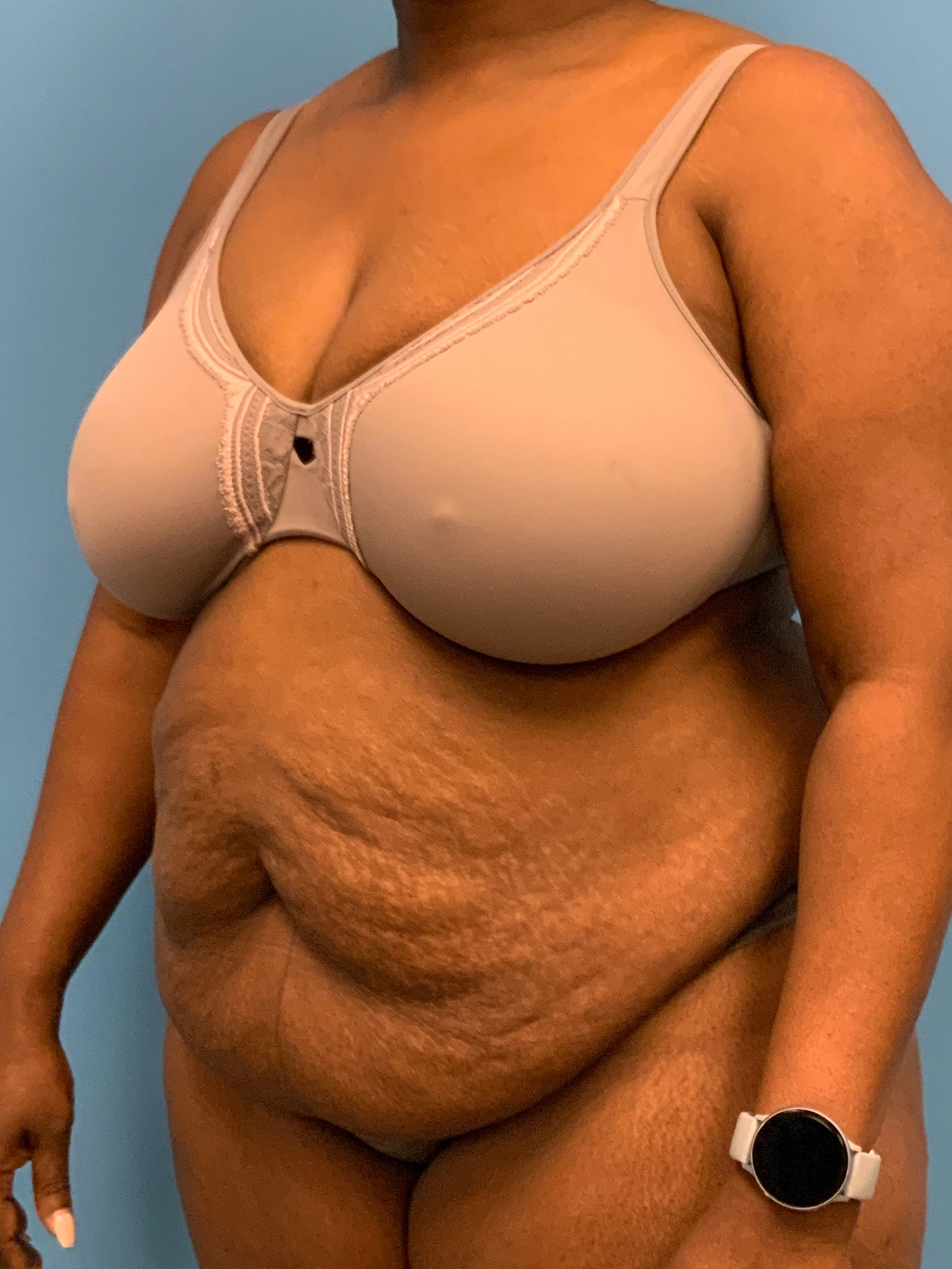 Abdominoplasty-Case--5907 | Before Tummy Tuck 4