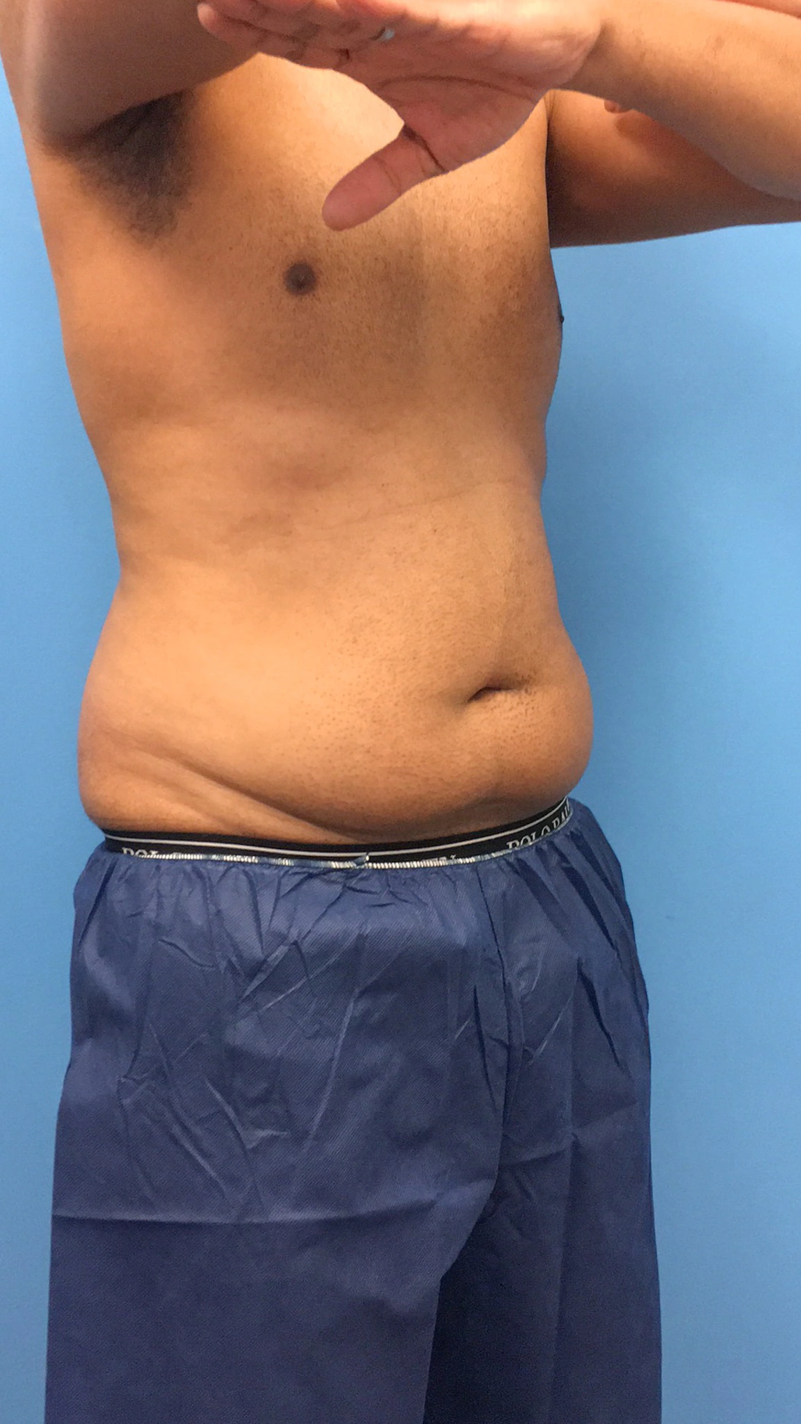 Lipo-360-Case--4979 | Before Liposuction 4