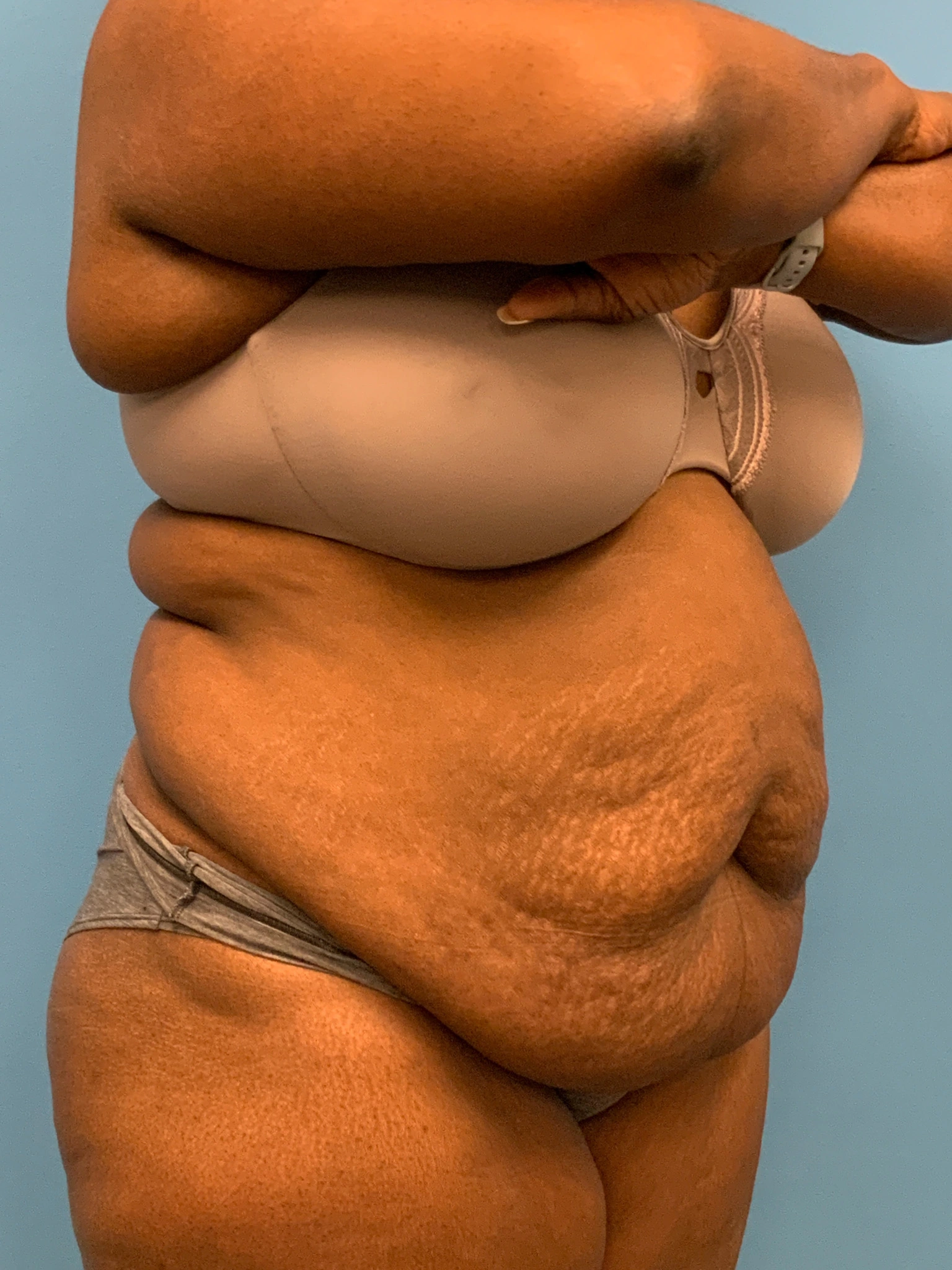 Abdominoplasty-Case--5907 | Before Tummy Tuck 5