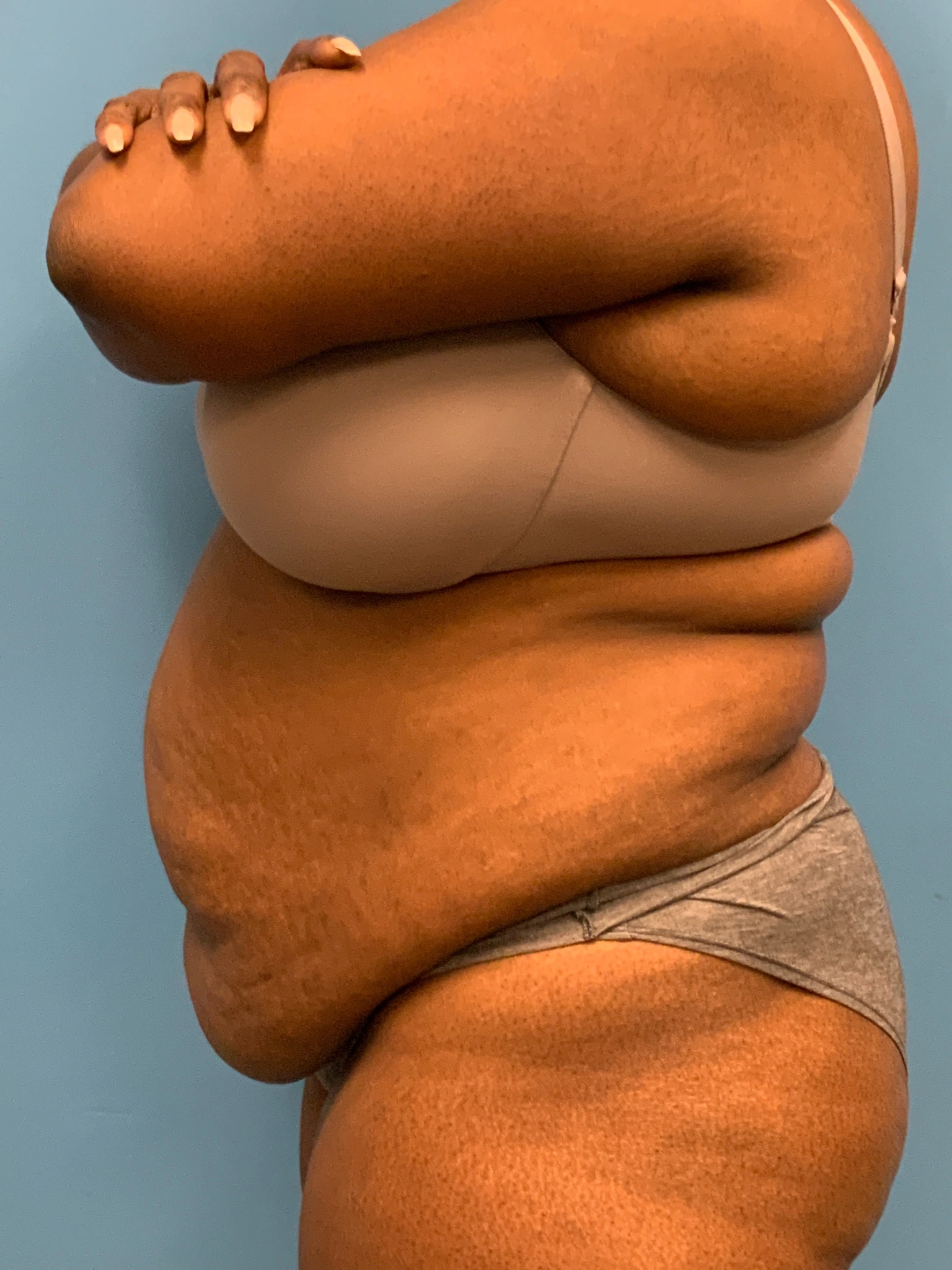 Abdominoplasty-Case--5907 | Before Tummy Tuck 2